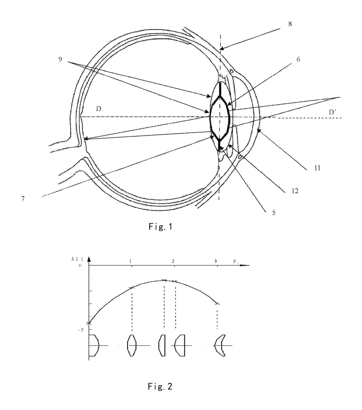 Posterior chamber intraocular lens