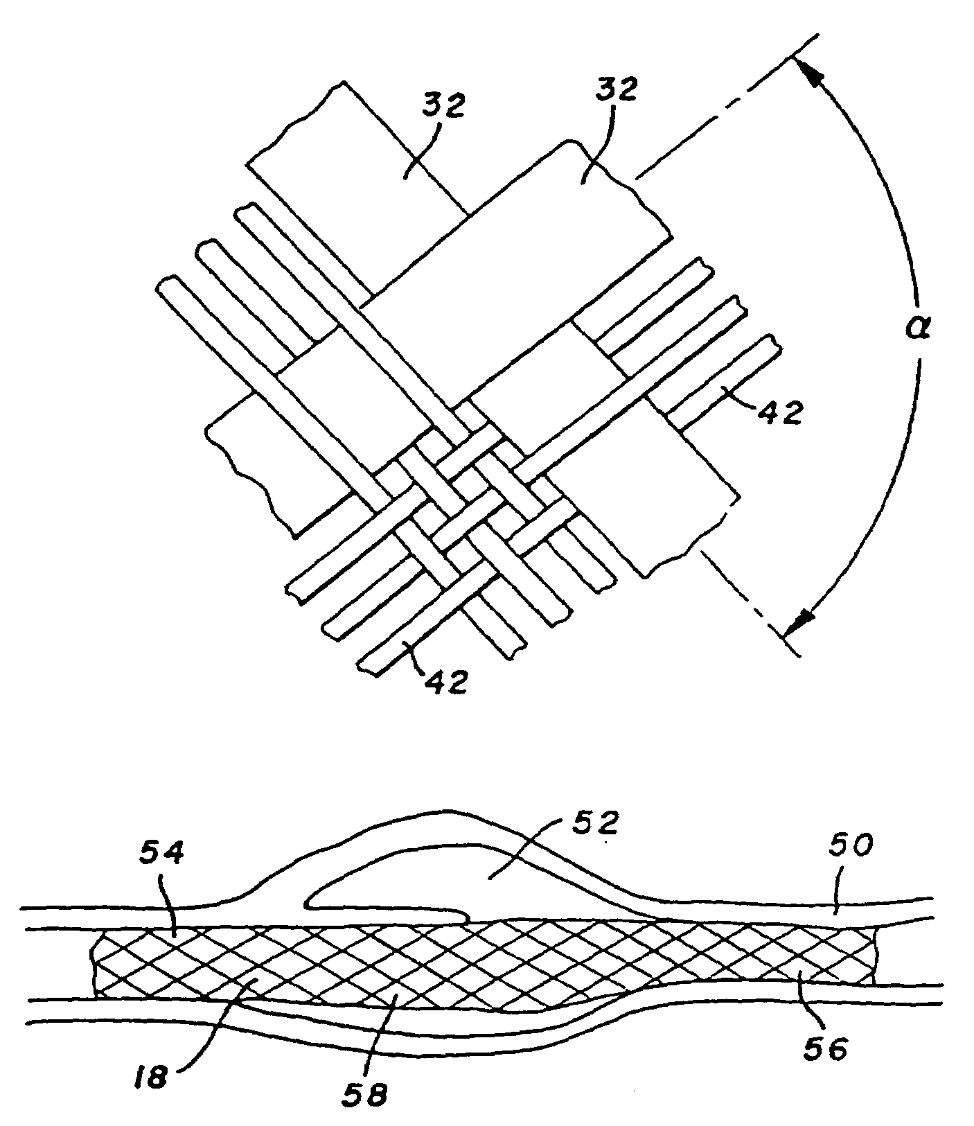 Three-dimensional braided covered stent