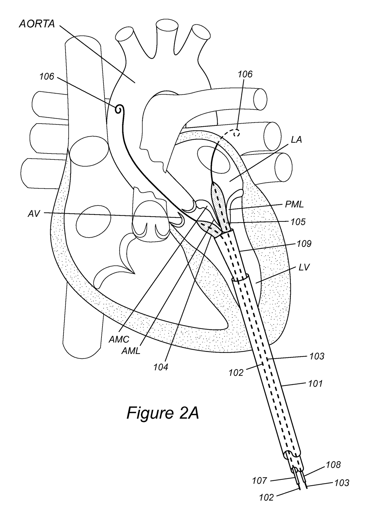 Anatomically-orientated and self-positioning transcatheter mitral valve