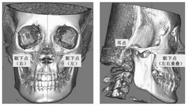 Method and system for positioning head shadow survey mark point based on CBCT (cone beam computed tomography) volume data