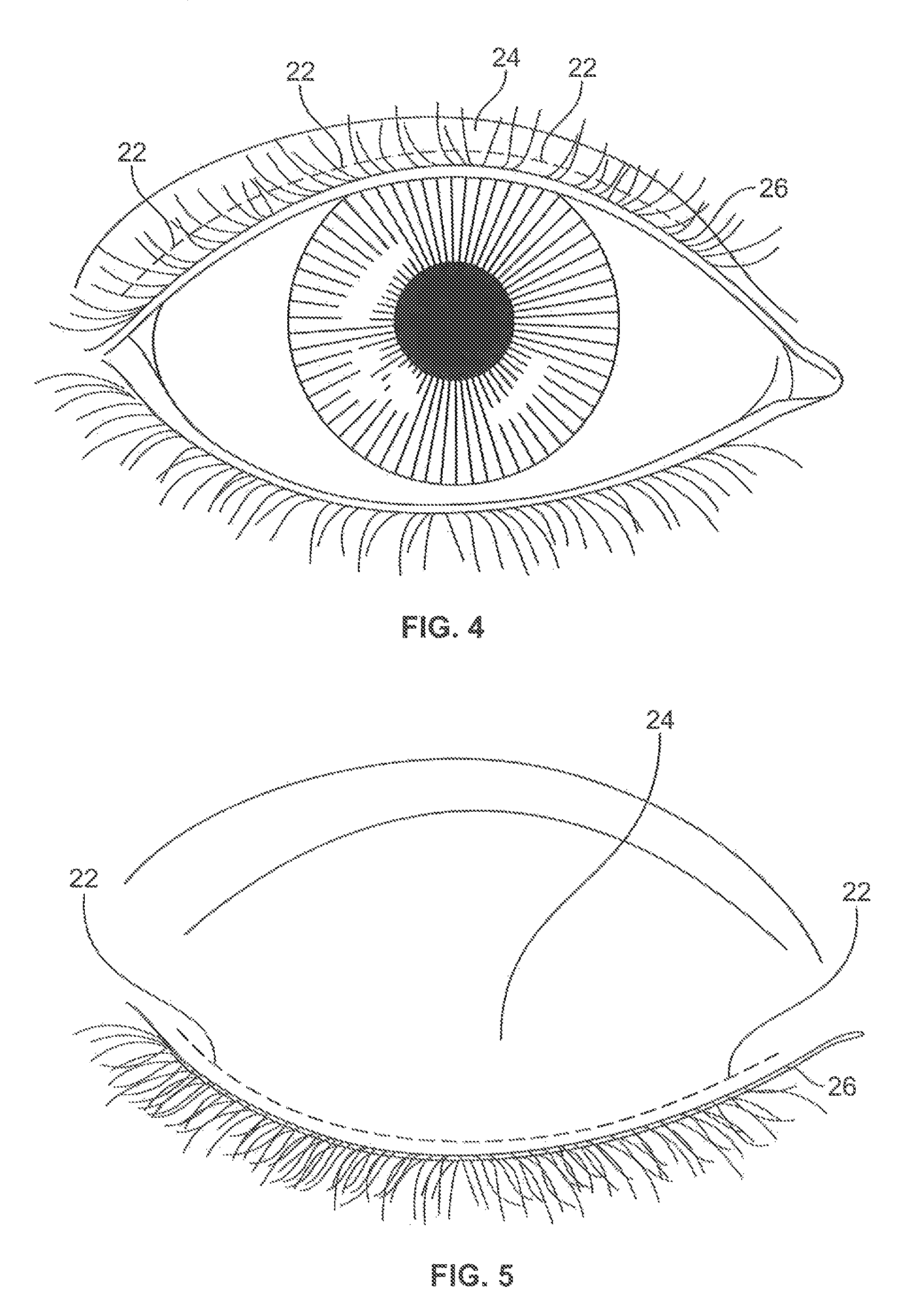 Ciliary implant, ciliary augmentation