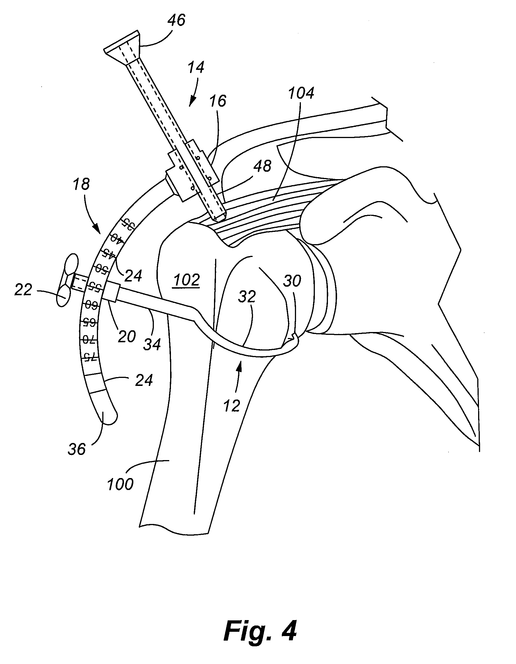 Apparatus and method for arthroscopic transhumeral rotator cuff repair