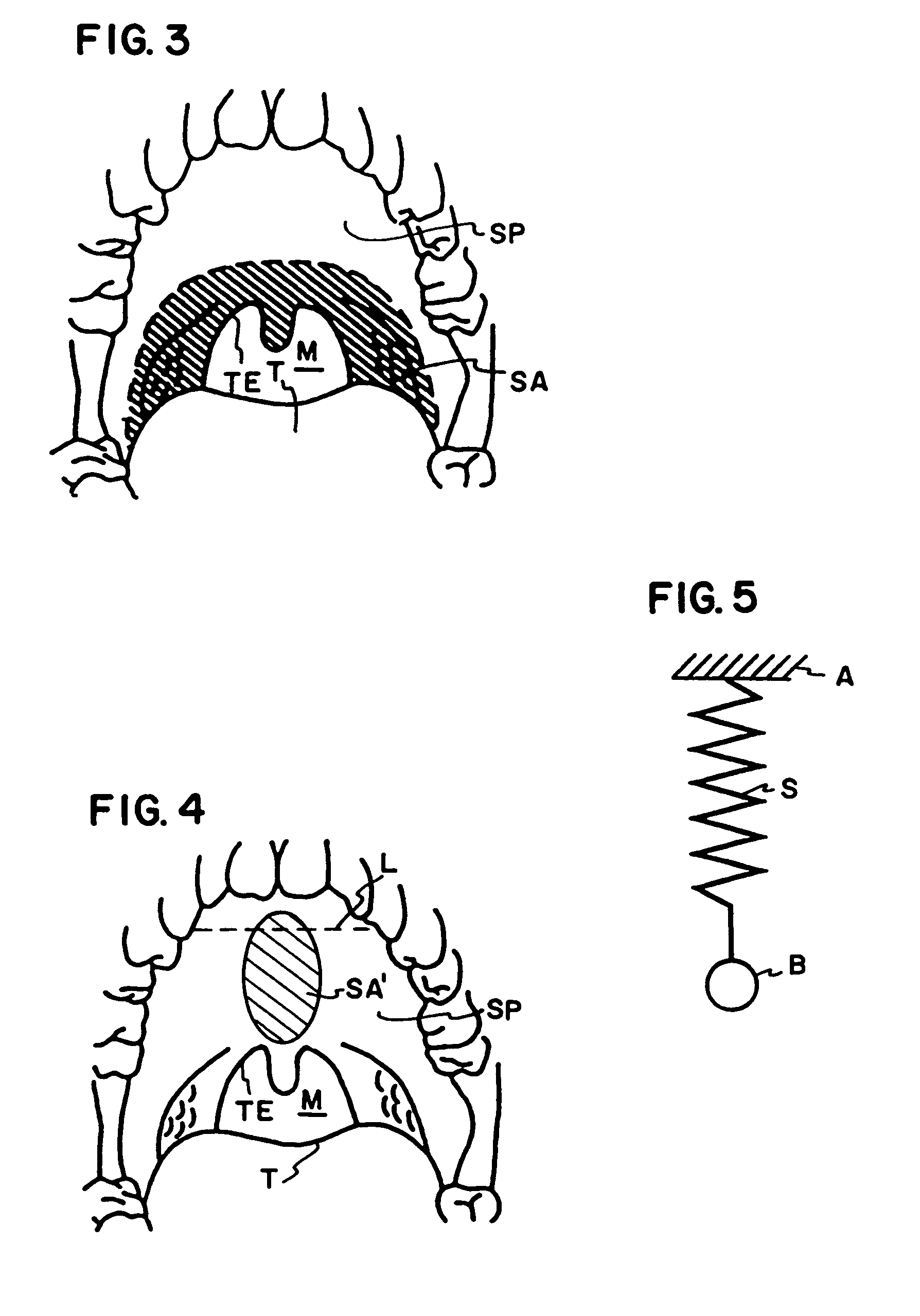 Airway stiffening implant