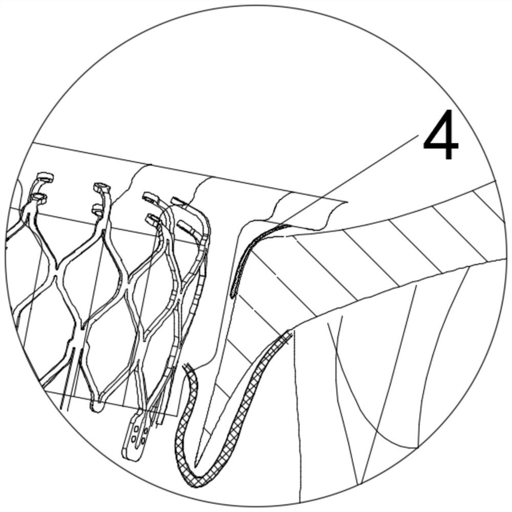 Valve prosthesis capable of effectively improving perivalvular leakage