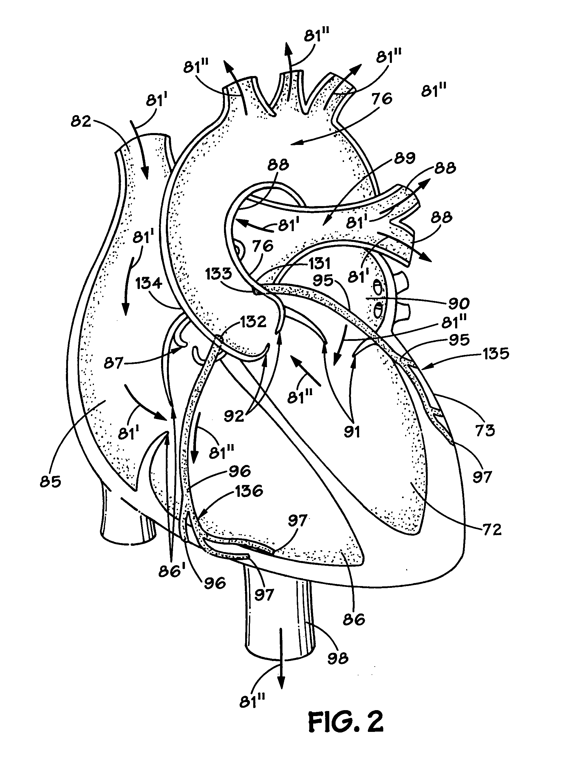 Method and apparatus for long-term assisting a left ventricle to pump blood