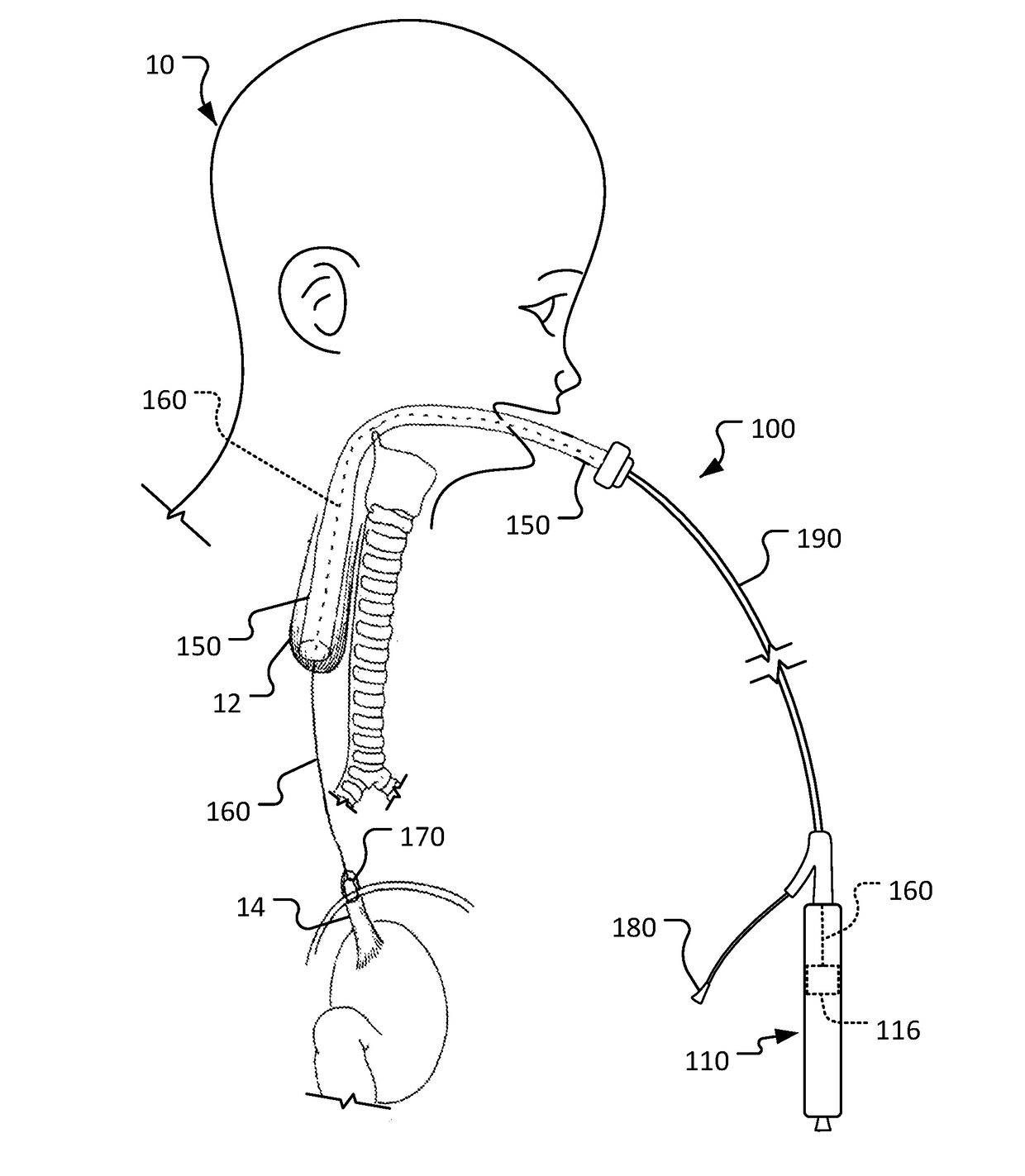 Medical devices and methods for body conduit lengthening and anastomosis formation