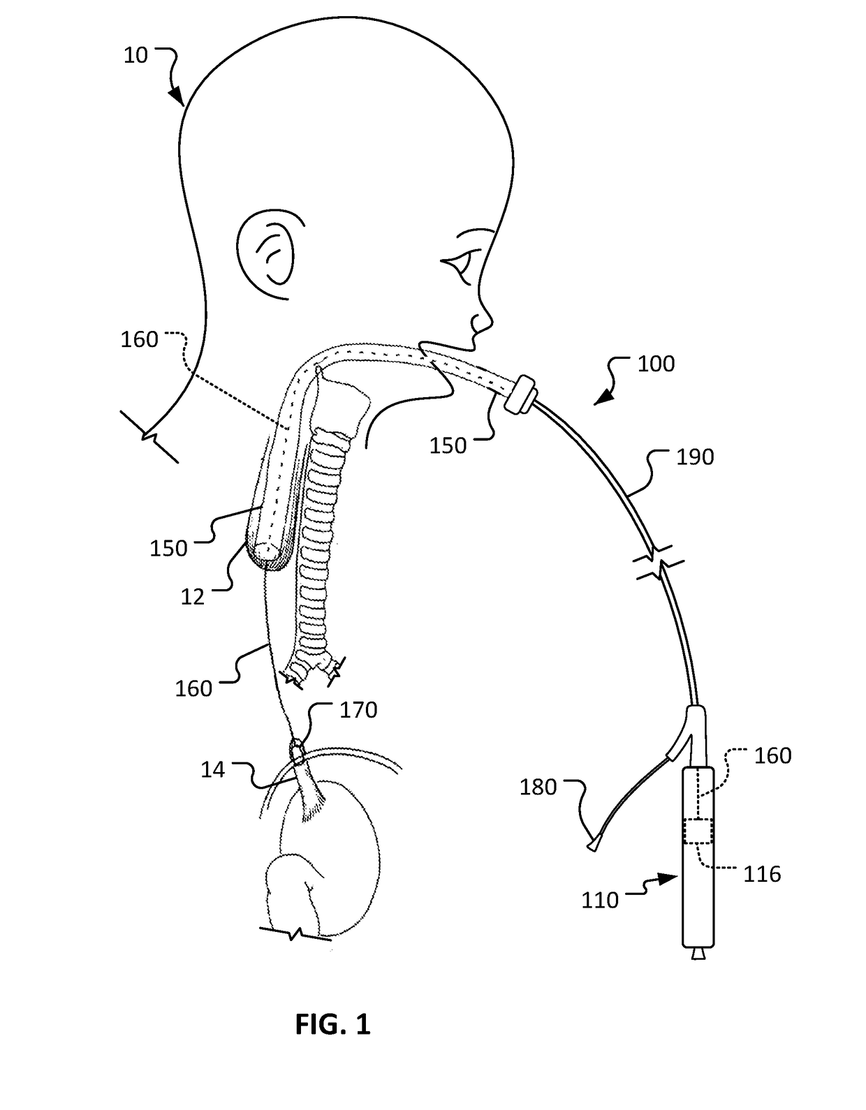 Medical devices and methods for body conduit lengthening and anastomosis formation