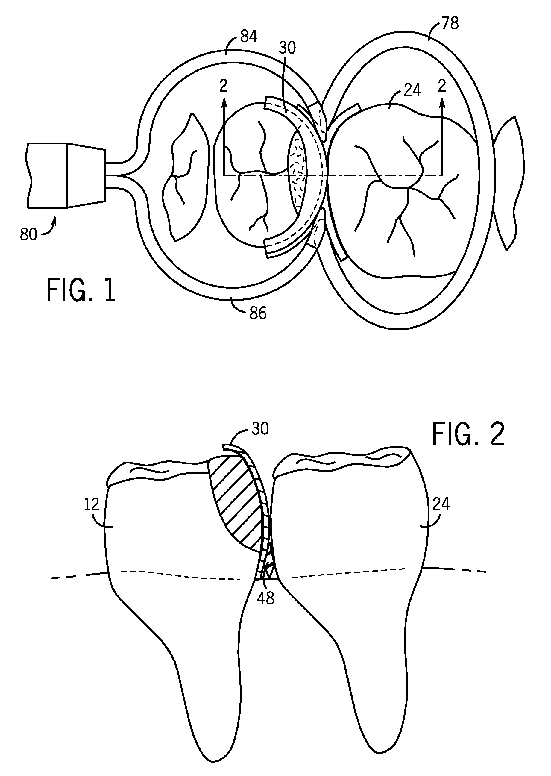 Devices And A Seamless, Single Load, Injection Molded Cavity Preparation And Filling Technique