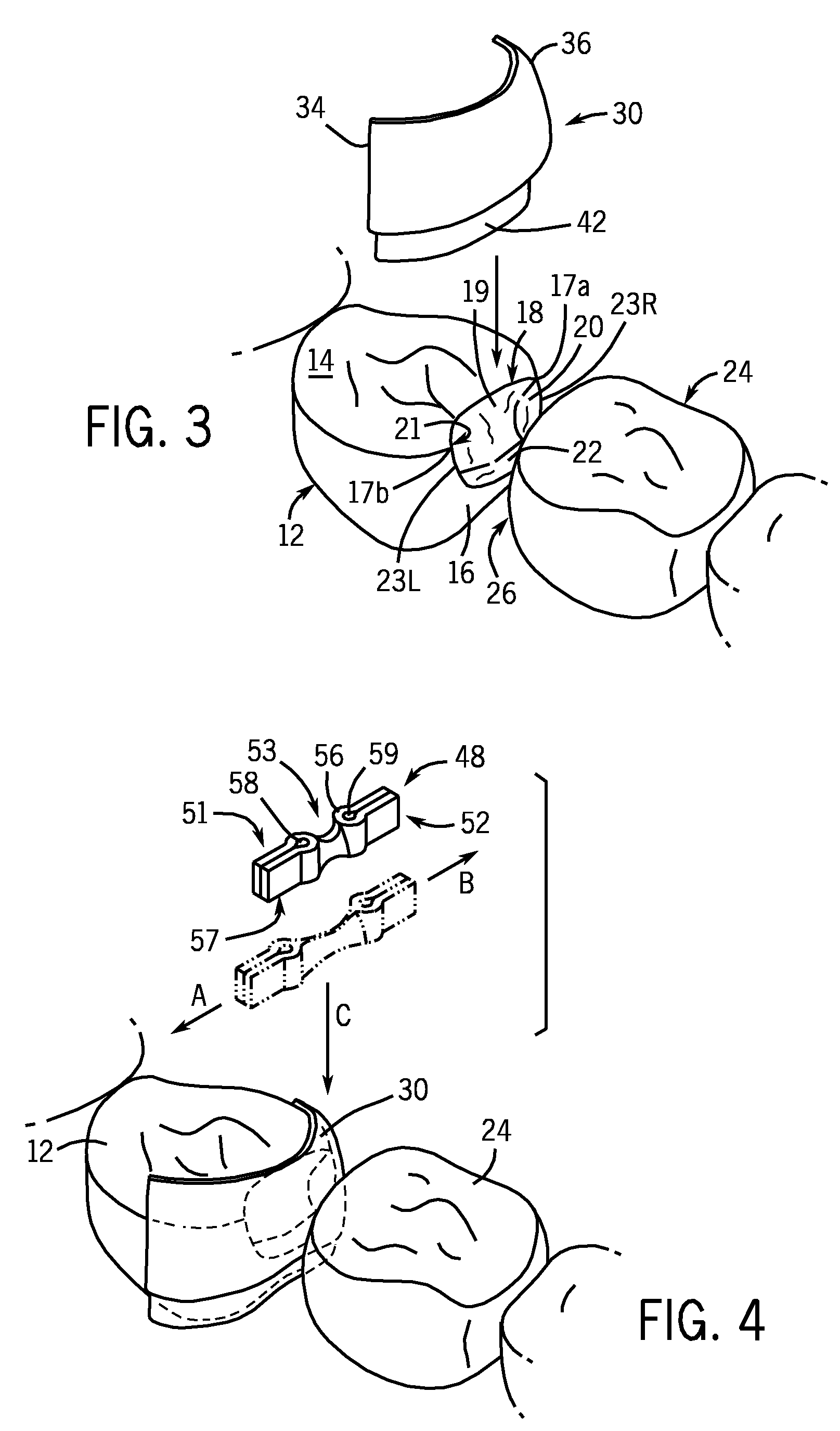 Devices And A Seamless, Single Load, Injection Molded Cavity Preparation And Filling Technique