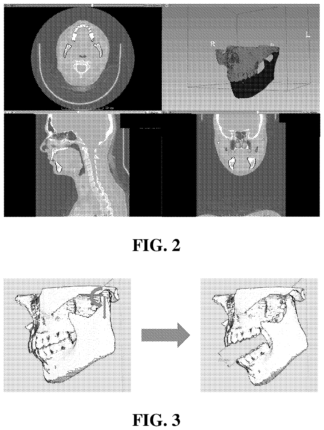 Apparatus and methods for three-dimensional printed oral stents for head and neck radiotherapy