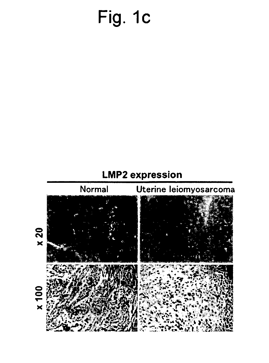 Detection of uterine leiomyosarcoma using lmp2