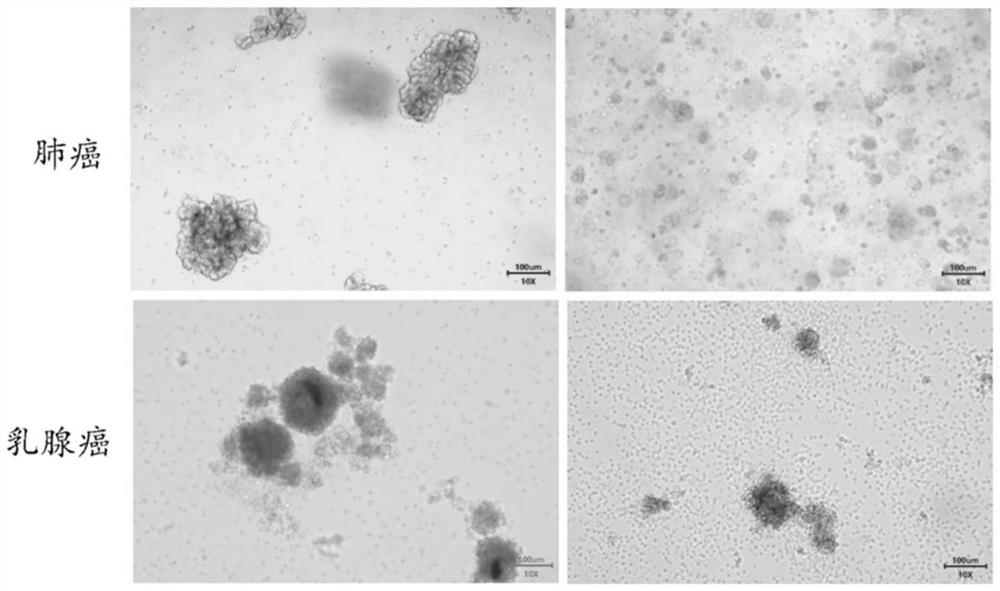 Method for individually culturing tumor organoid by using hydrogel prepared from autologous chest and ascites of tumor patient