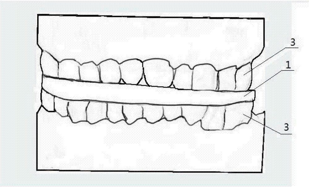 Bonded and fixed bite plate