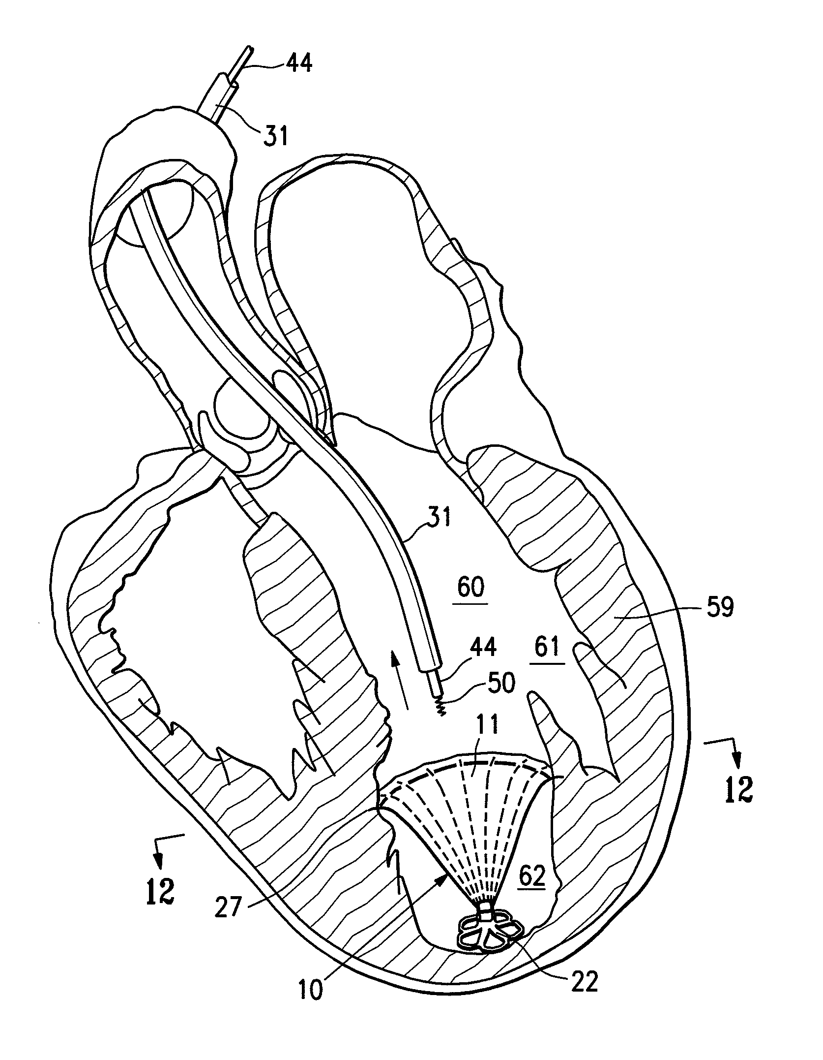 Peripheral seal for a ventricular partitioning device