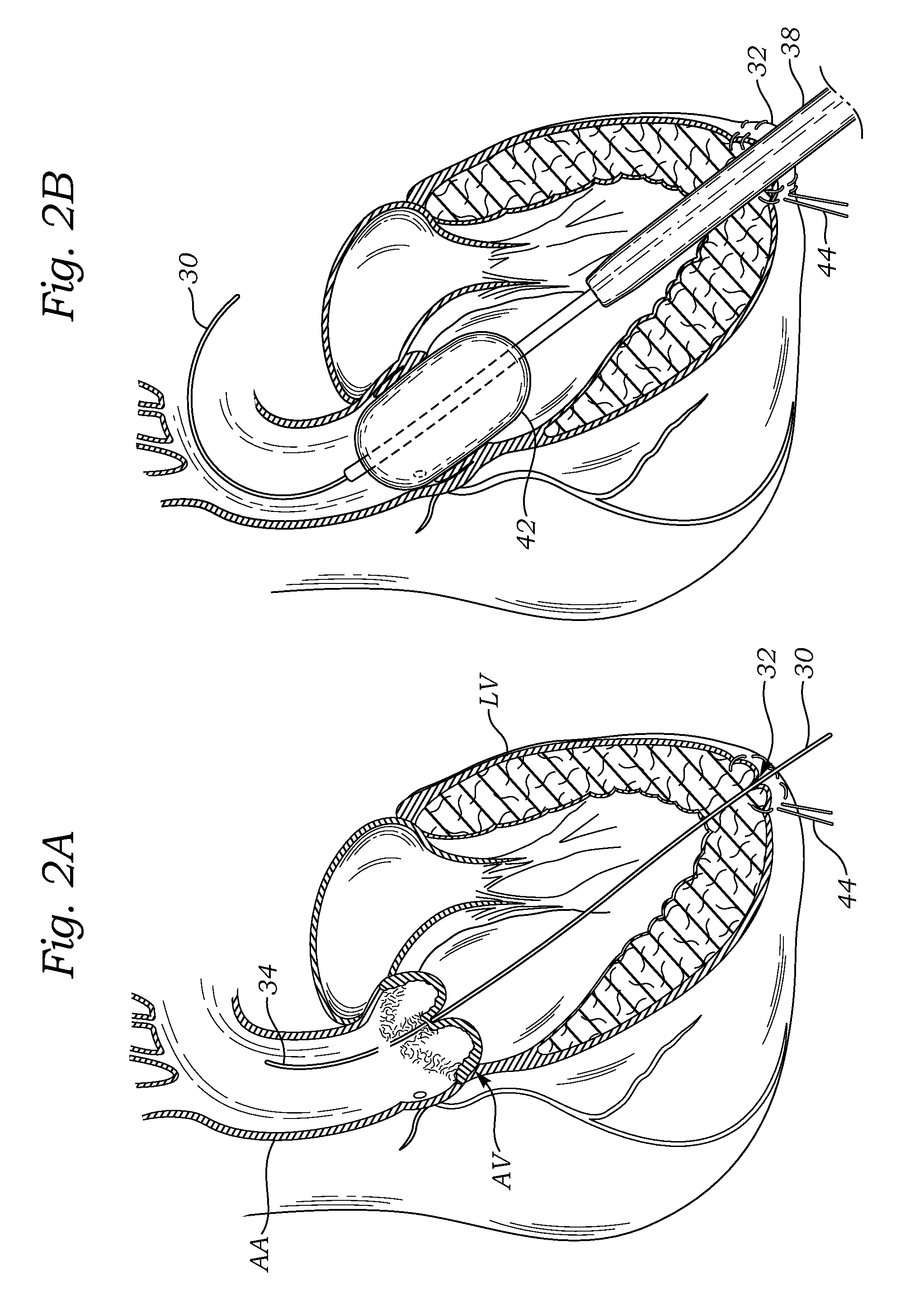 Transapical delivery system for heart valves