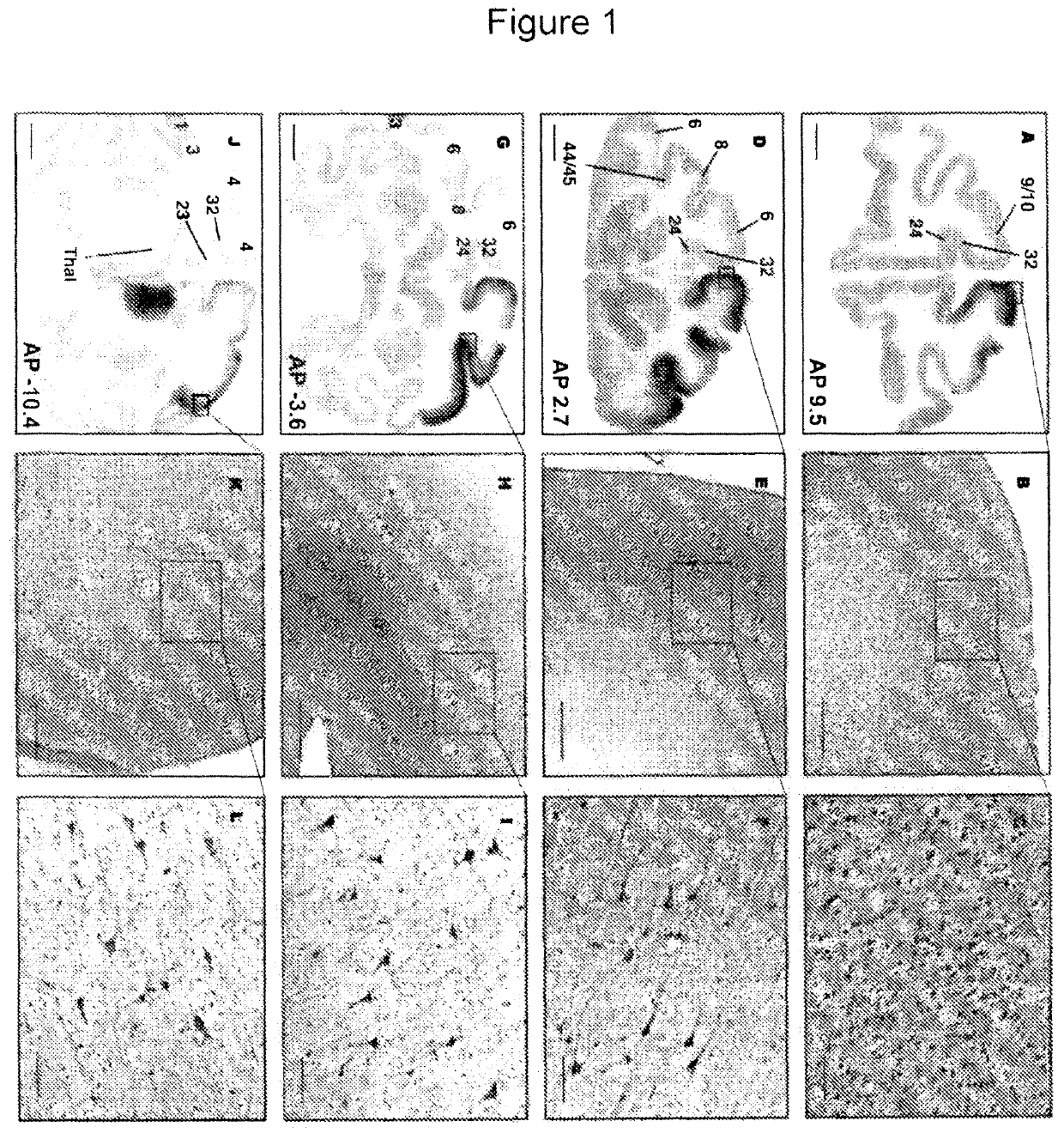 Methods for distributing high levels of therapeutic agent throughout the cortex to treat neurological disorders