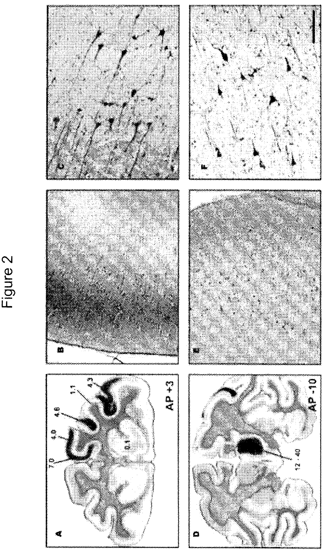 Methods for distributing high levels of therapeutic agent throughout the cortex to treat neurological disorders