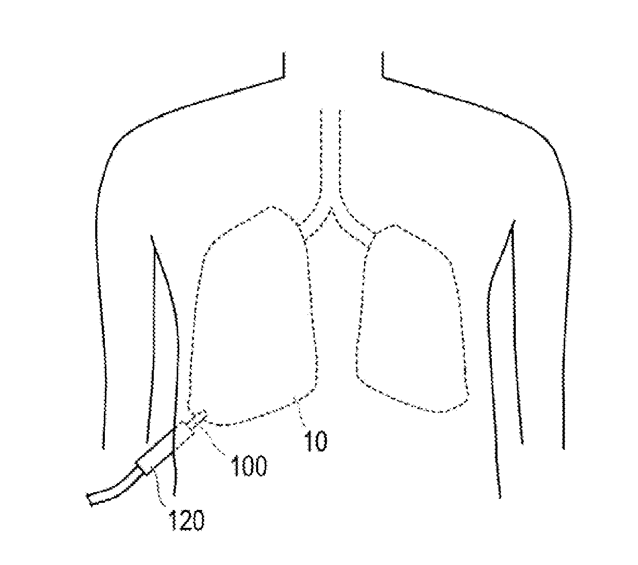 Lung volume reduction method