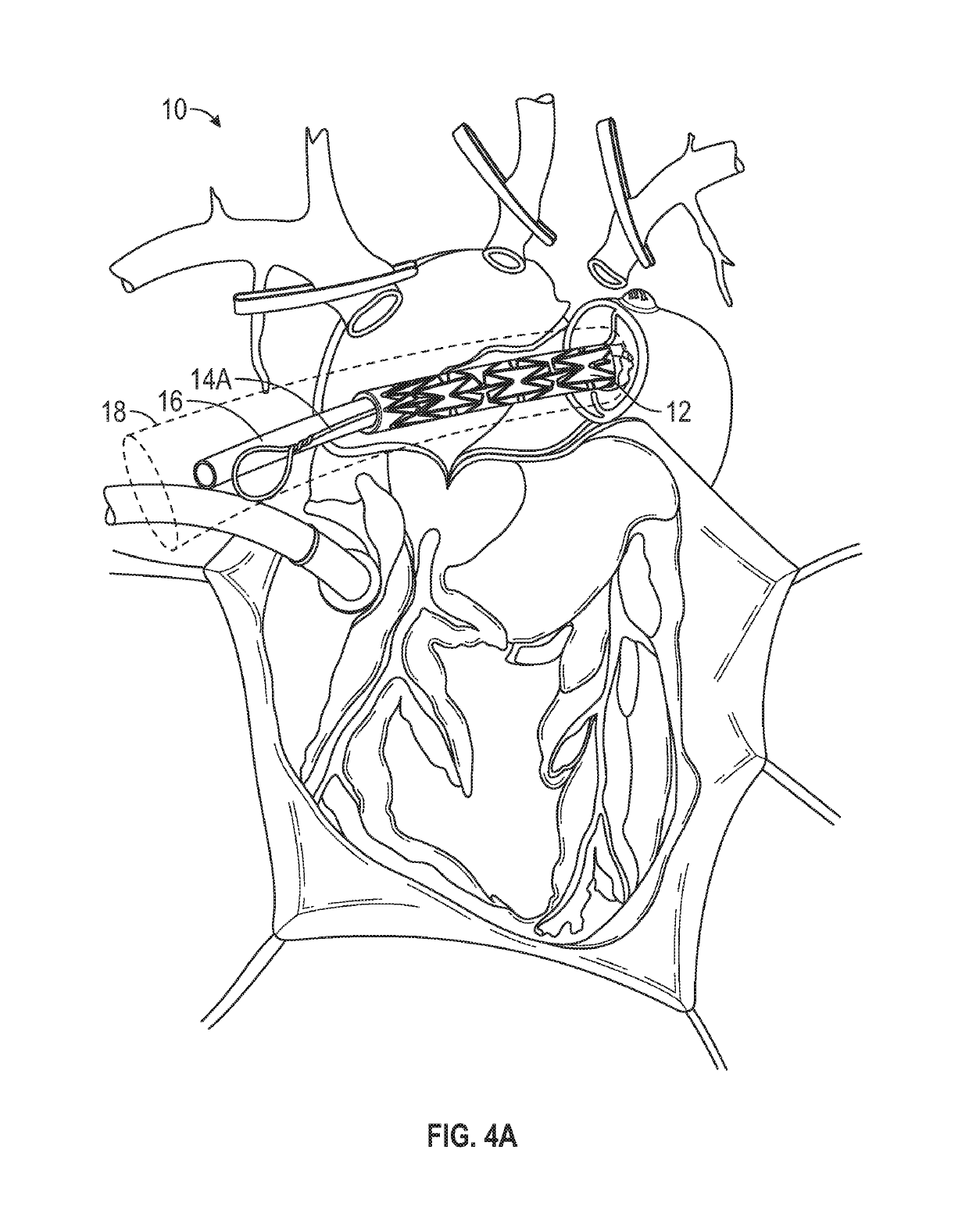 Aortic Arch Embolic Protection Device