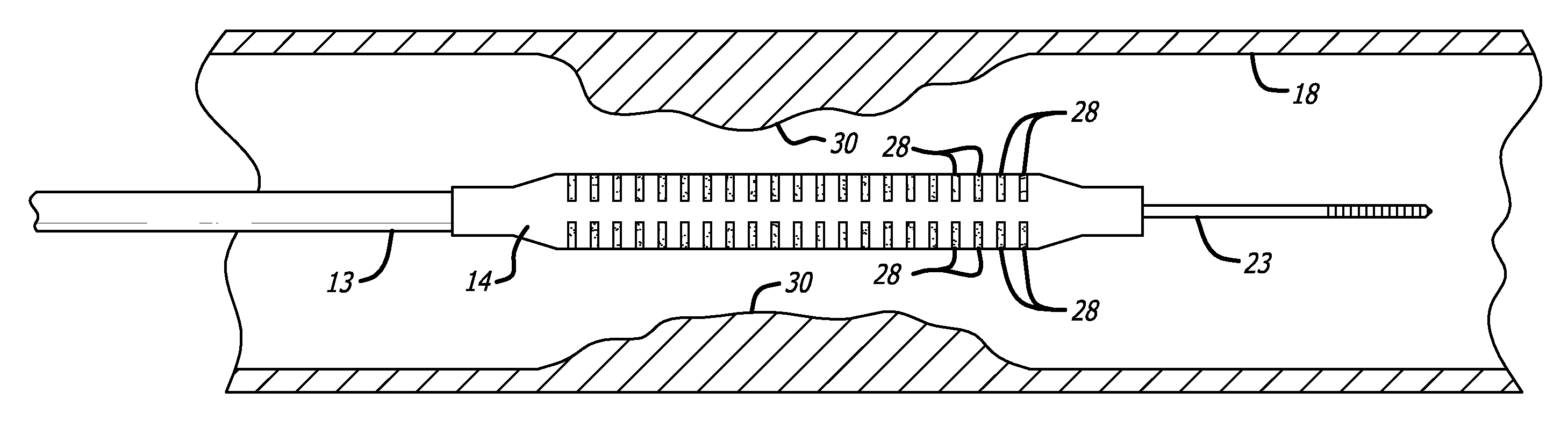 Delivery system with incremental markers