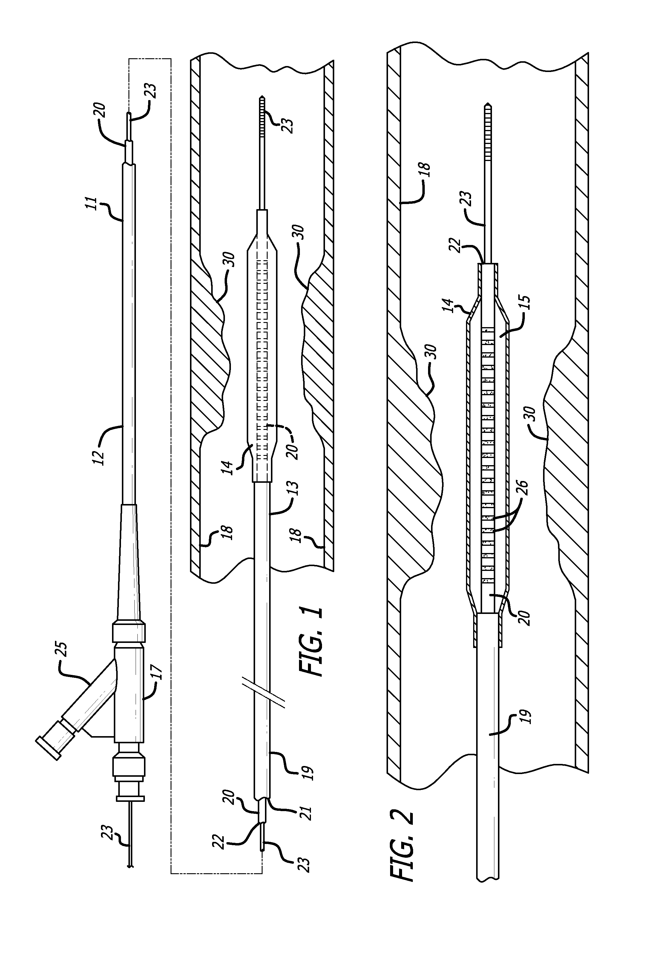 Delivery system with incremental markers