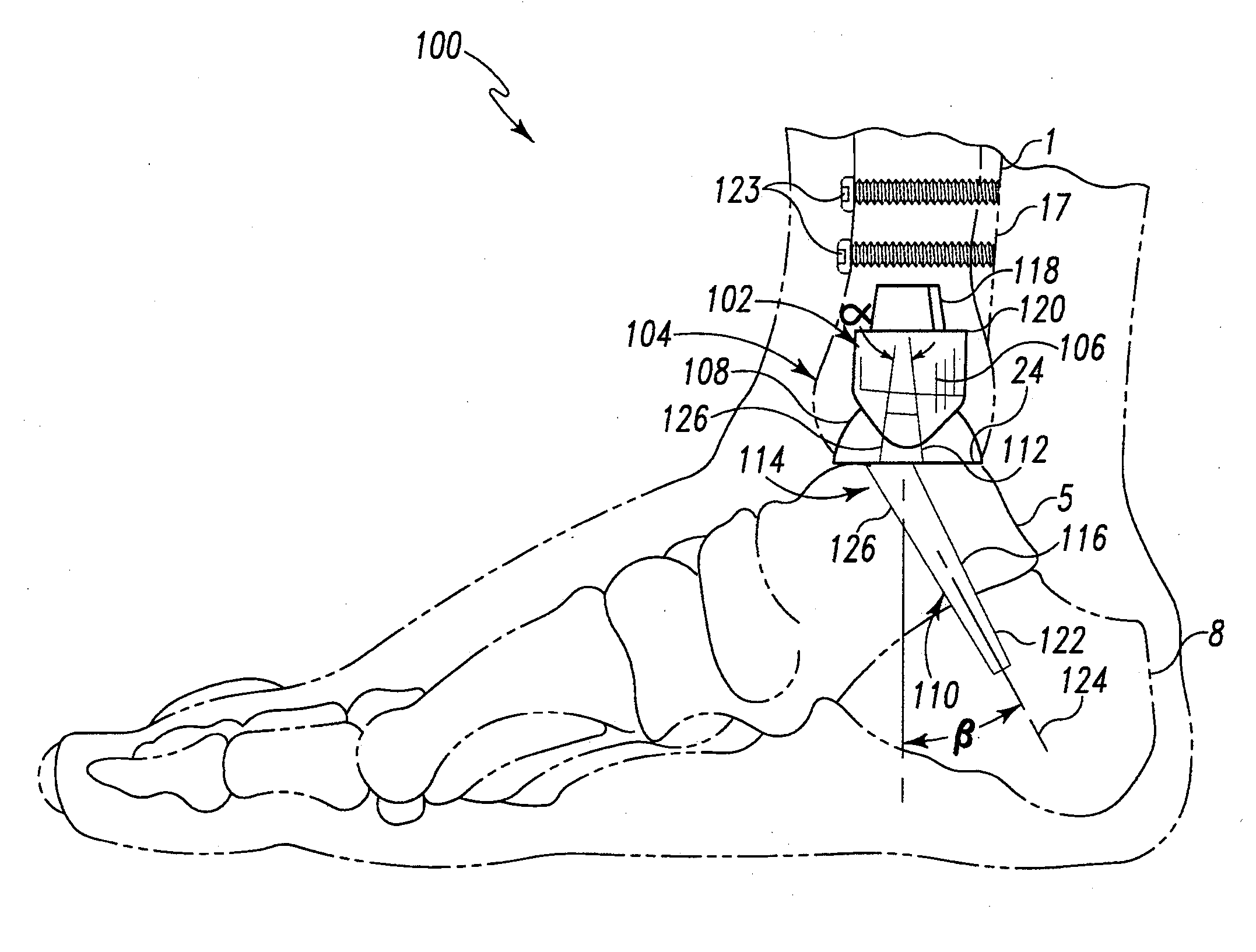 Modular Ankle Prosthesis and Associated Method