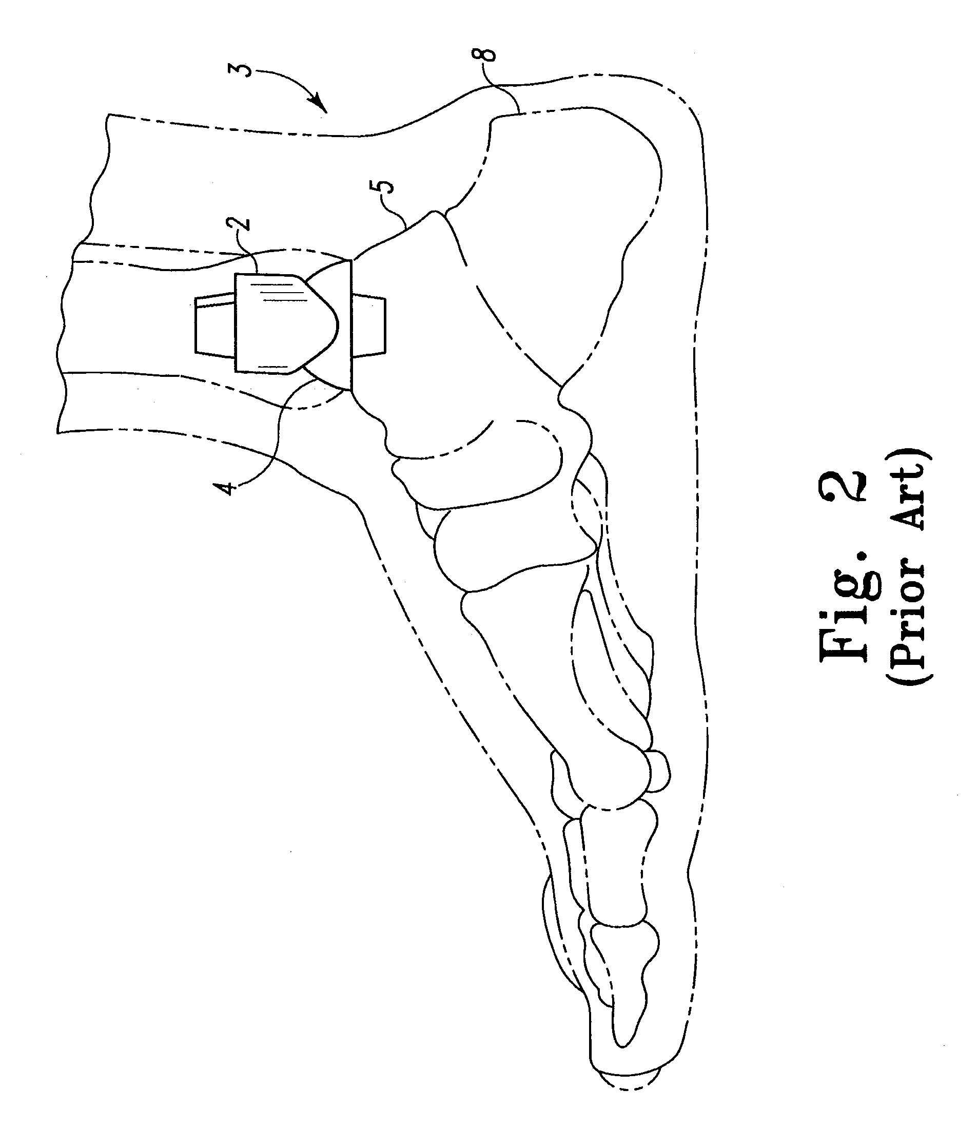Modular Ankle Prosthesis and Associated Method