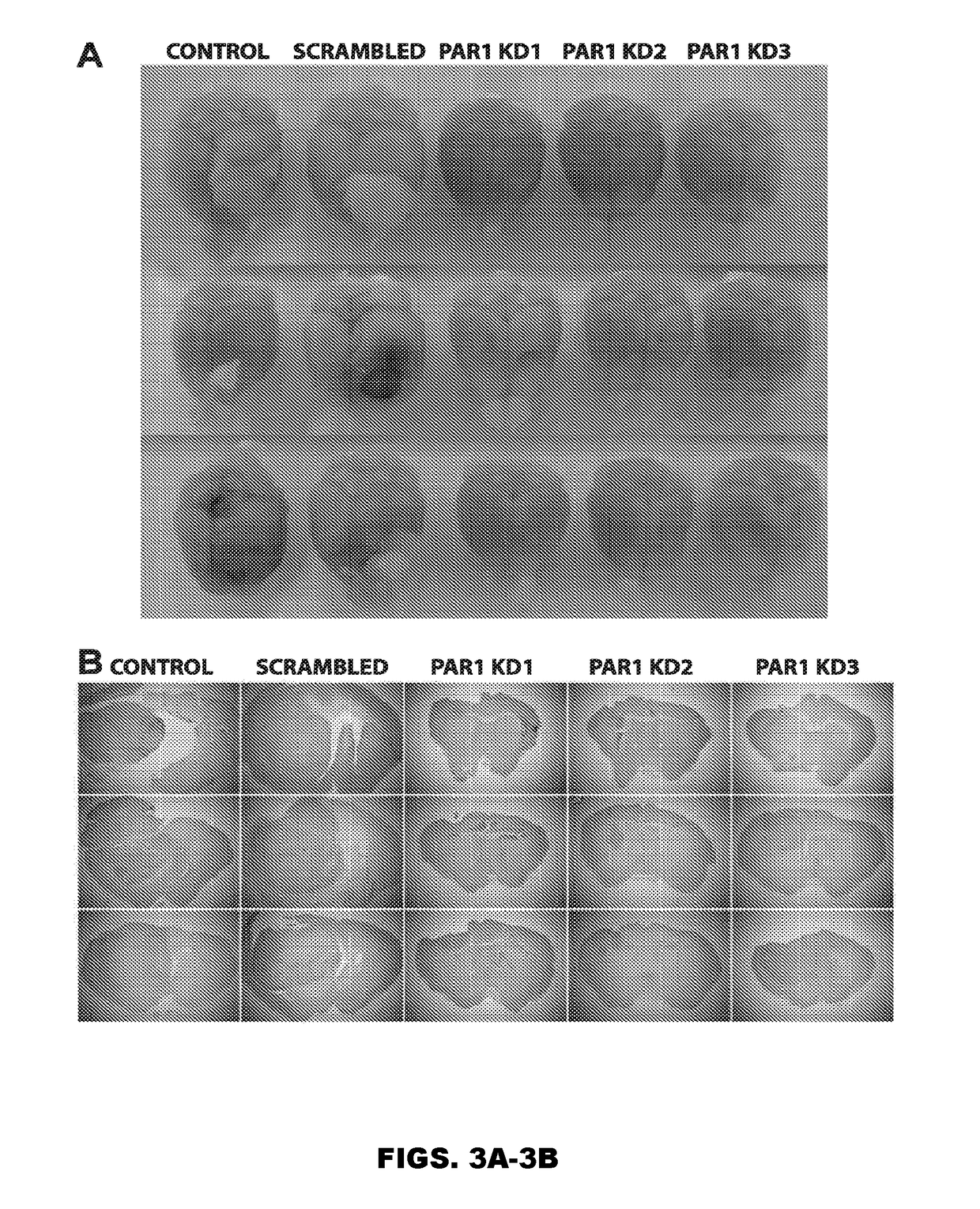 Use of inhibitors of binding between a par-1 receptor and its ligands for the treatment of glioma