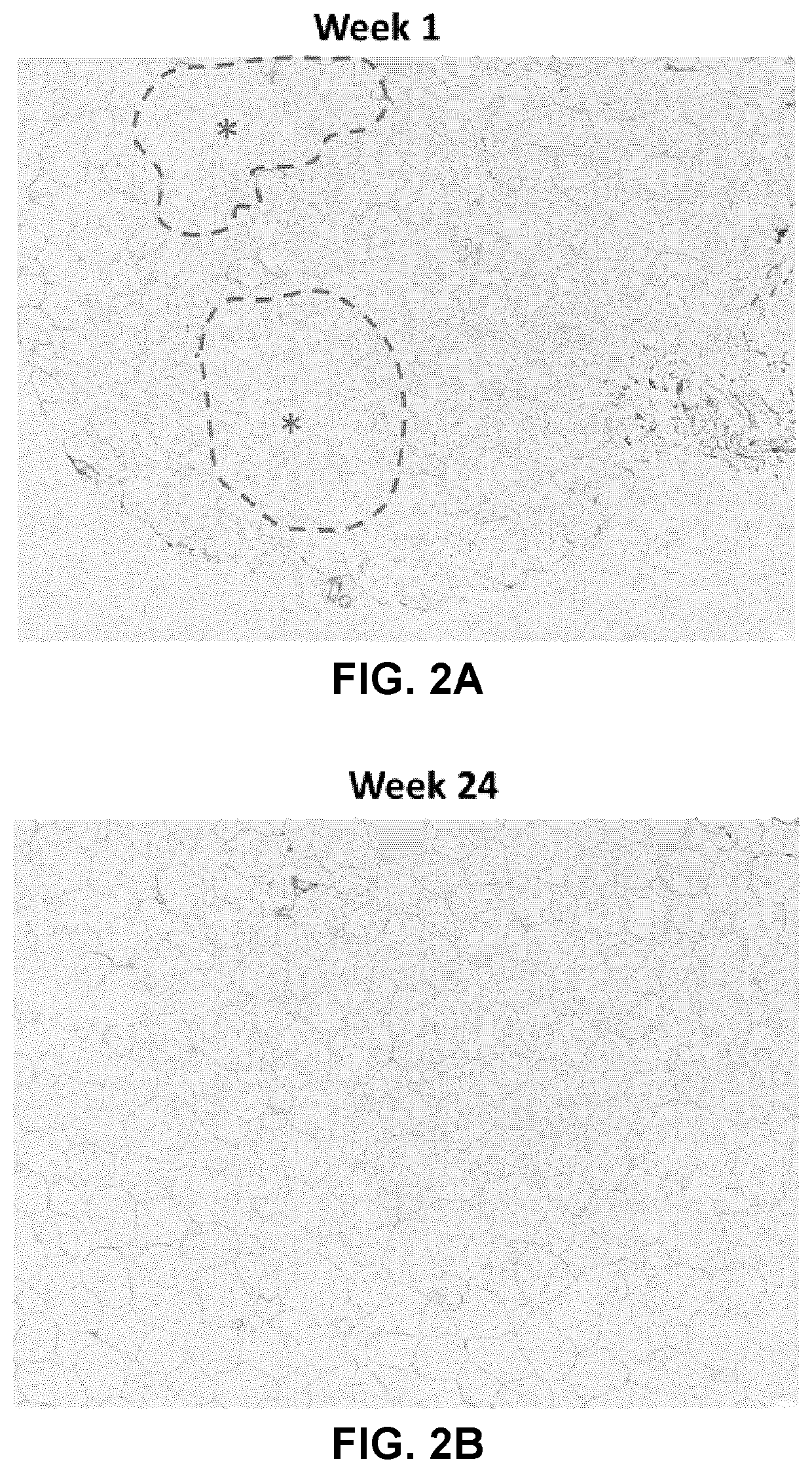 Use of sodium 2-(3-pentylphenyl)acetate in the treatment of alström syndrome