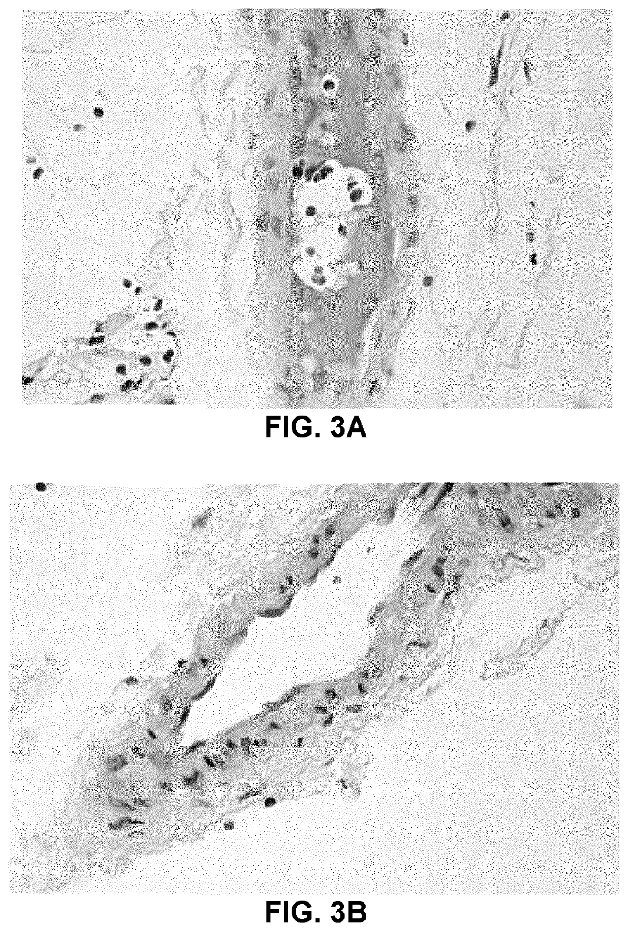 Use of sodium 2-(3-pentylphenyl)acetate in the treatment of alström syndrome