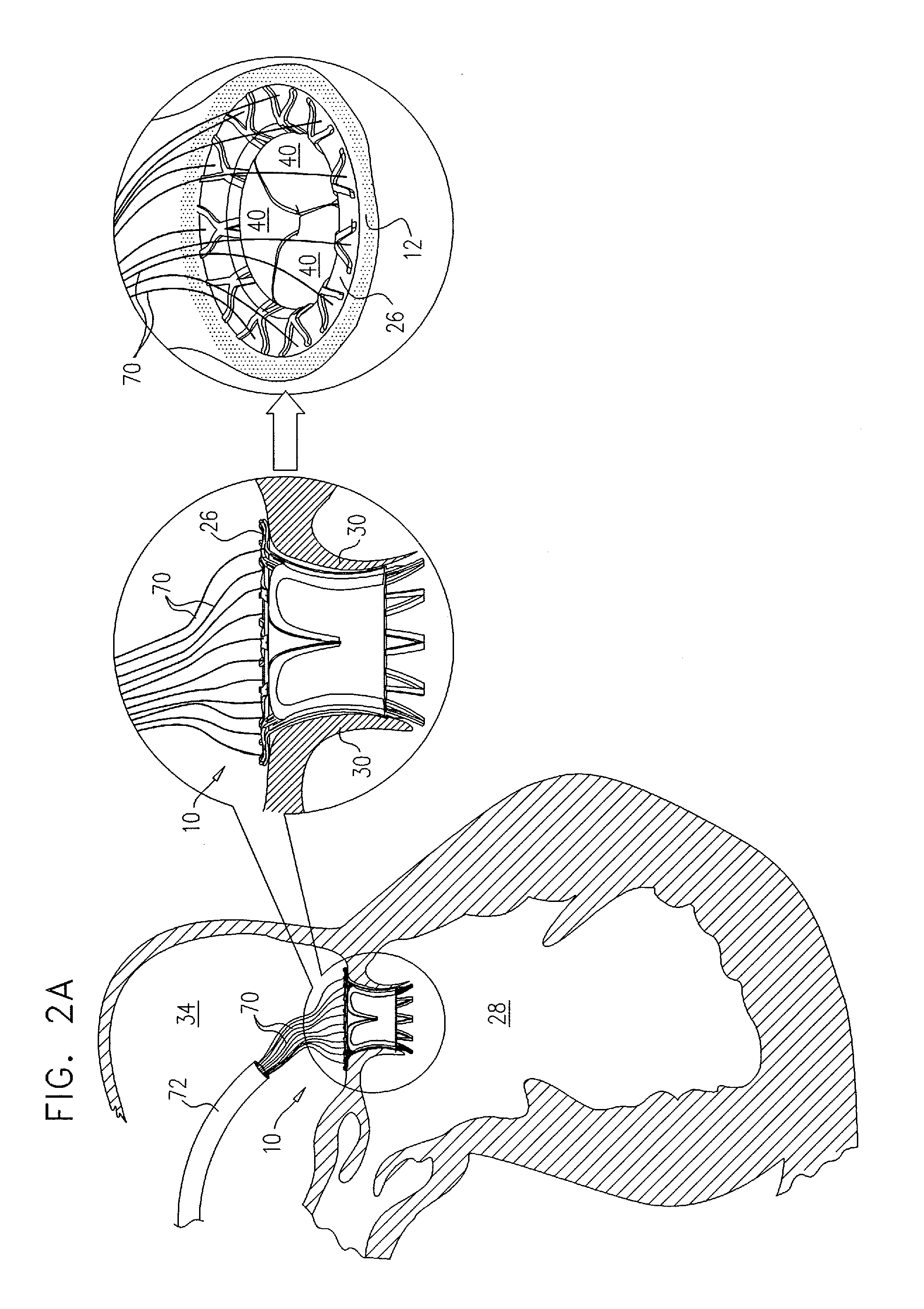 Prosthetic mitral valve with tissue anchors