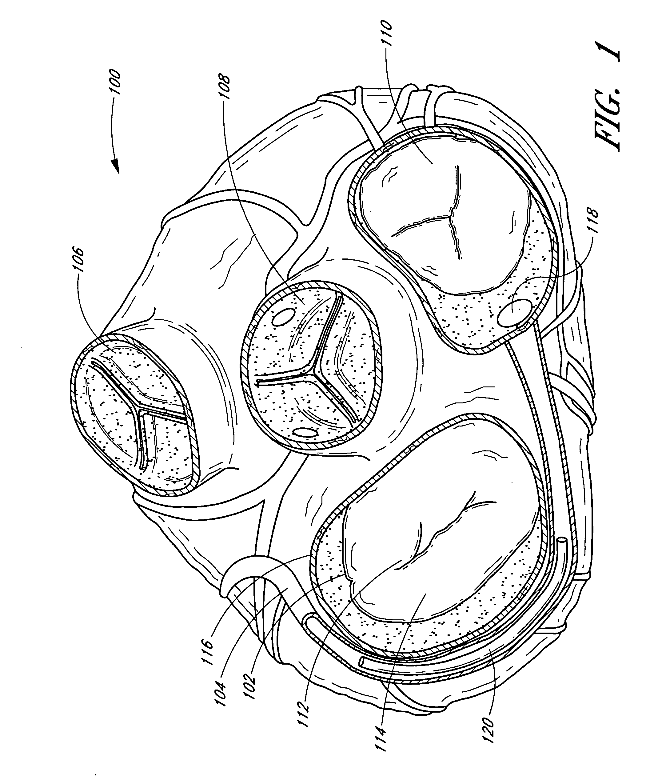 Dynamically adjustable implants and methods for reshaping tissue