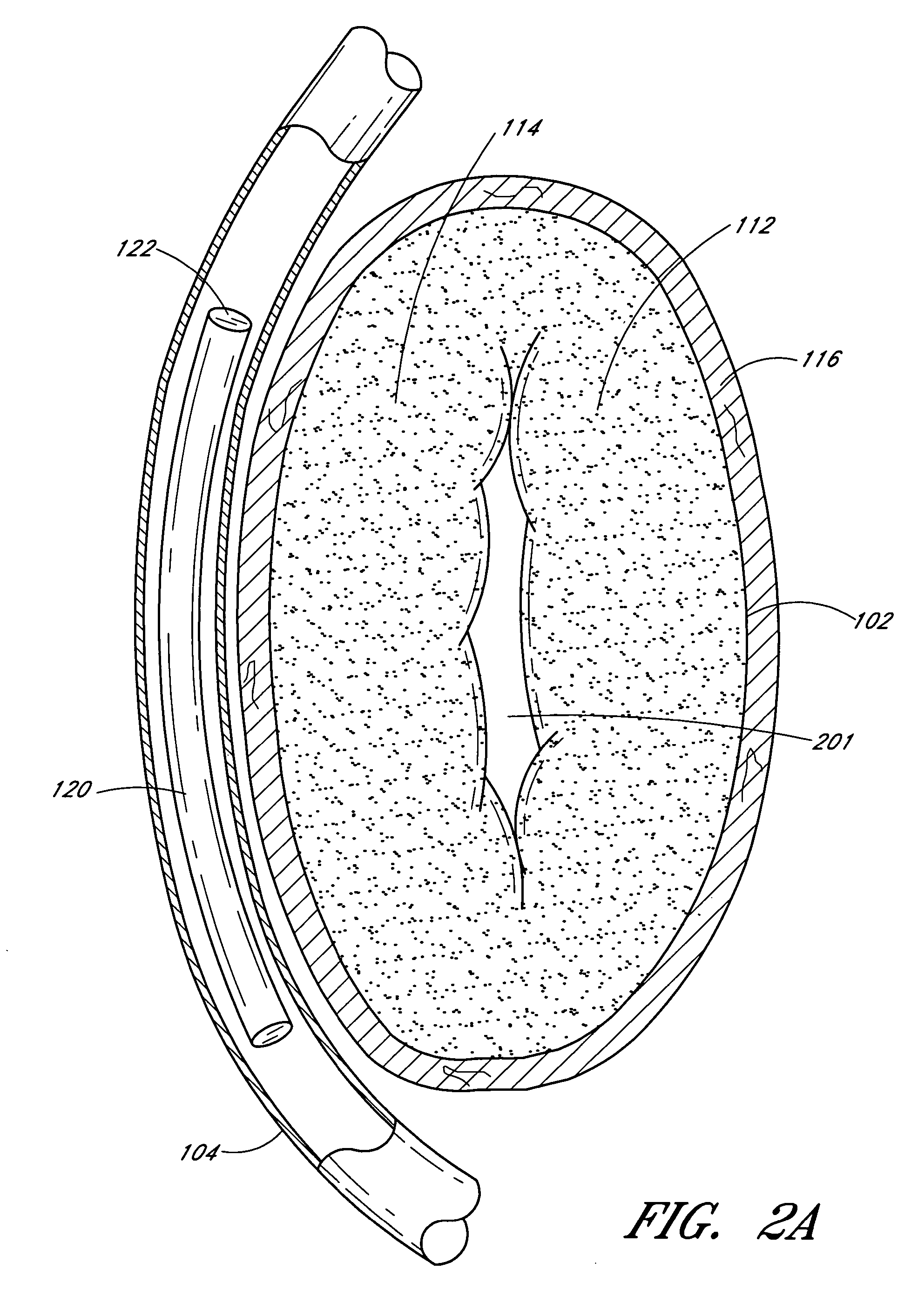 Dynamically adjustable implants and methods for reshaping tissue