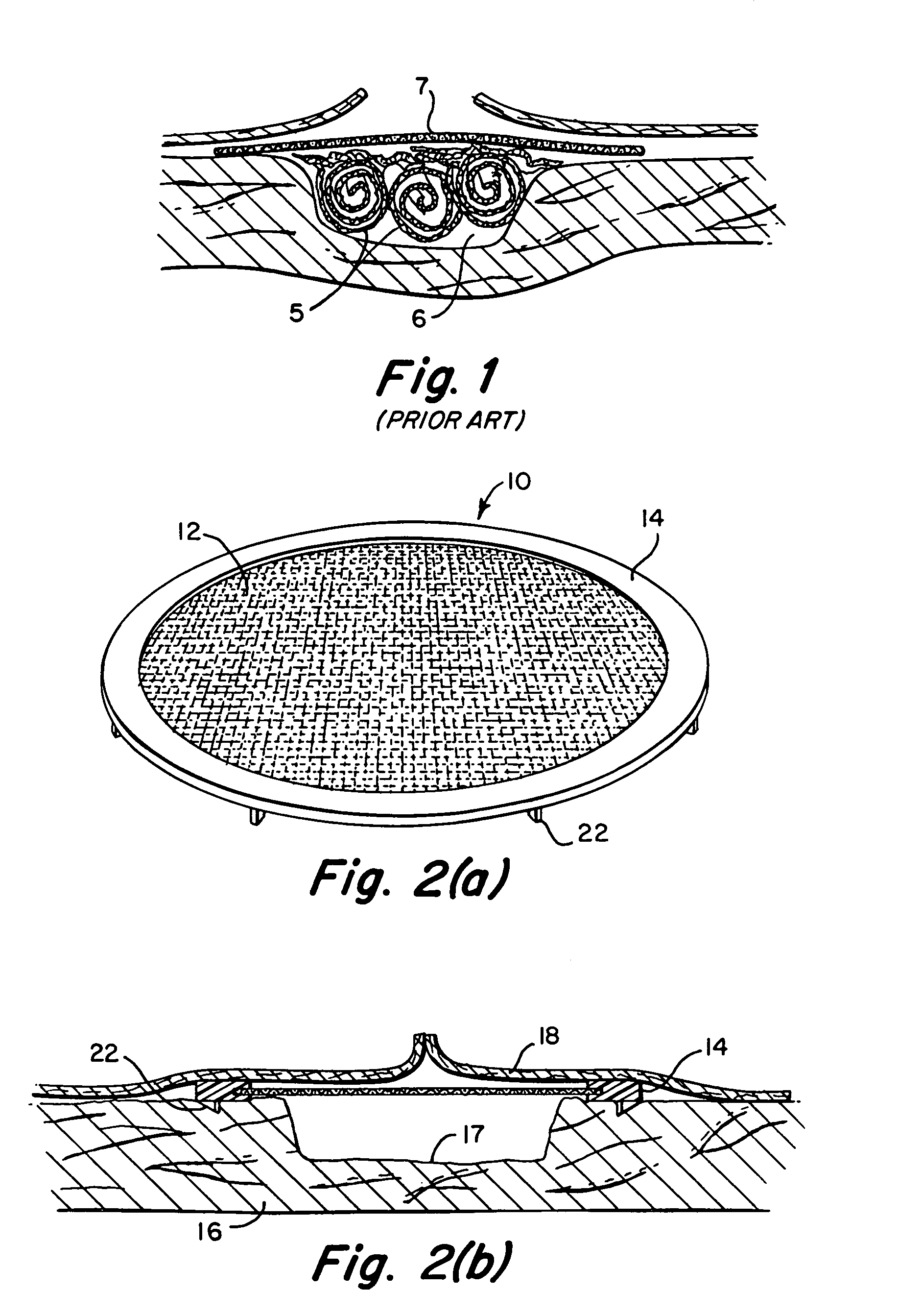 Implantable prosthesis and method and apparatus for loading and delivering an implantable prosthesis