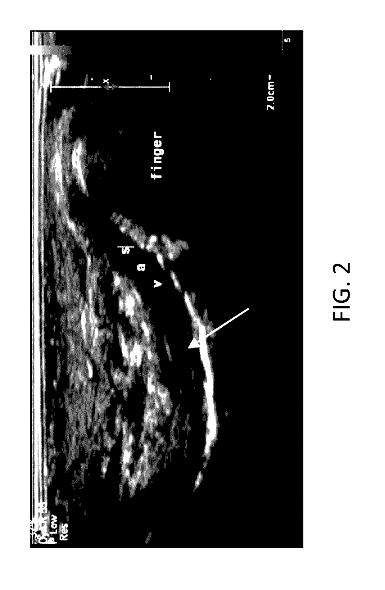 Compositions and methods for vas-occlusive contraception