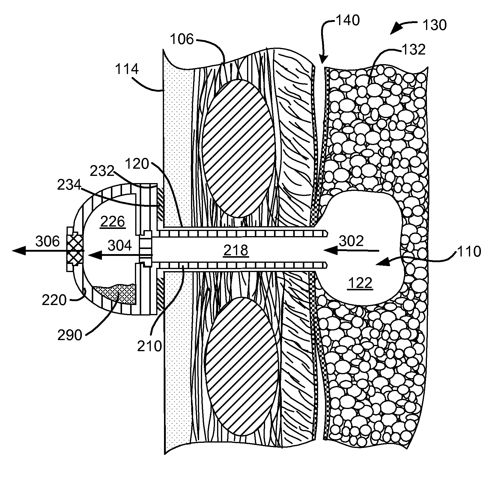 Pneumostoma management device and method for treatment of chronic obstructive pulmonary disease