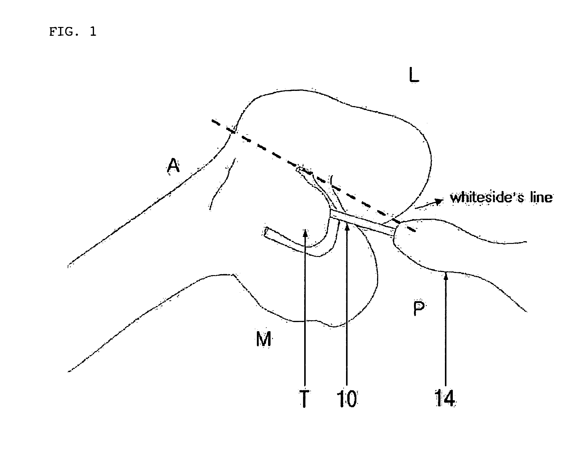Method and system for cutting knee joint using robot