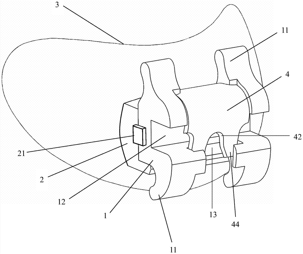 A manufacturing method of a personalized lingual straight wire arch self-locking bracket appliance