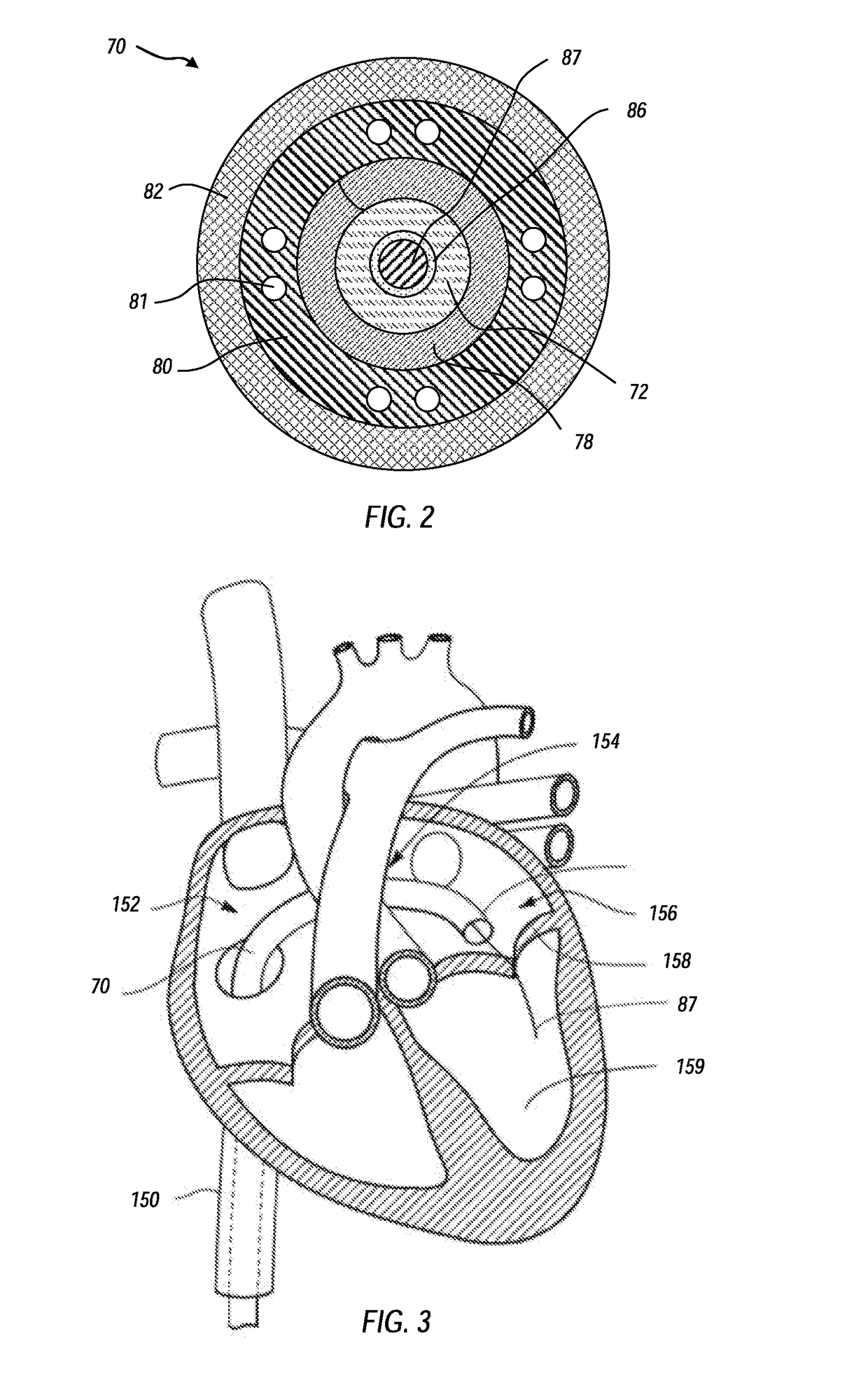 Systems and methods for delivering an intravascular device to the mitral annulus
