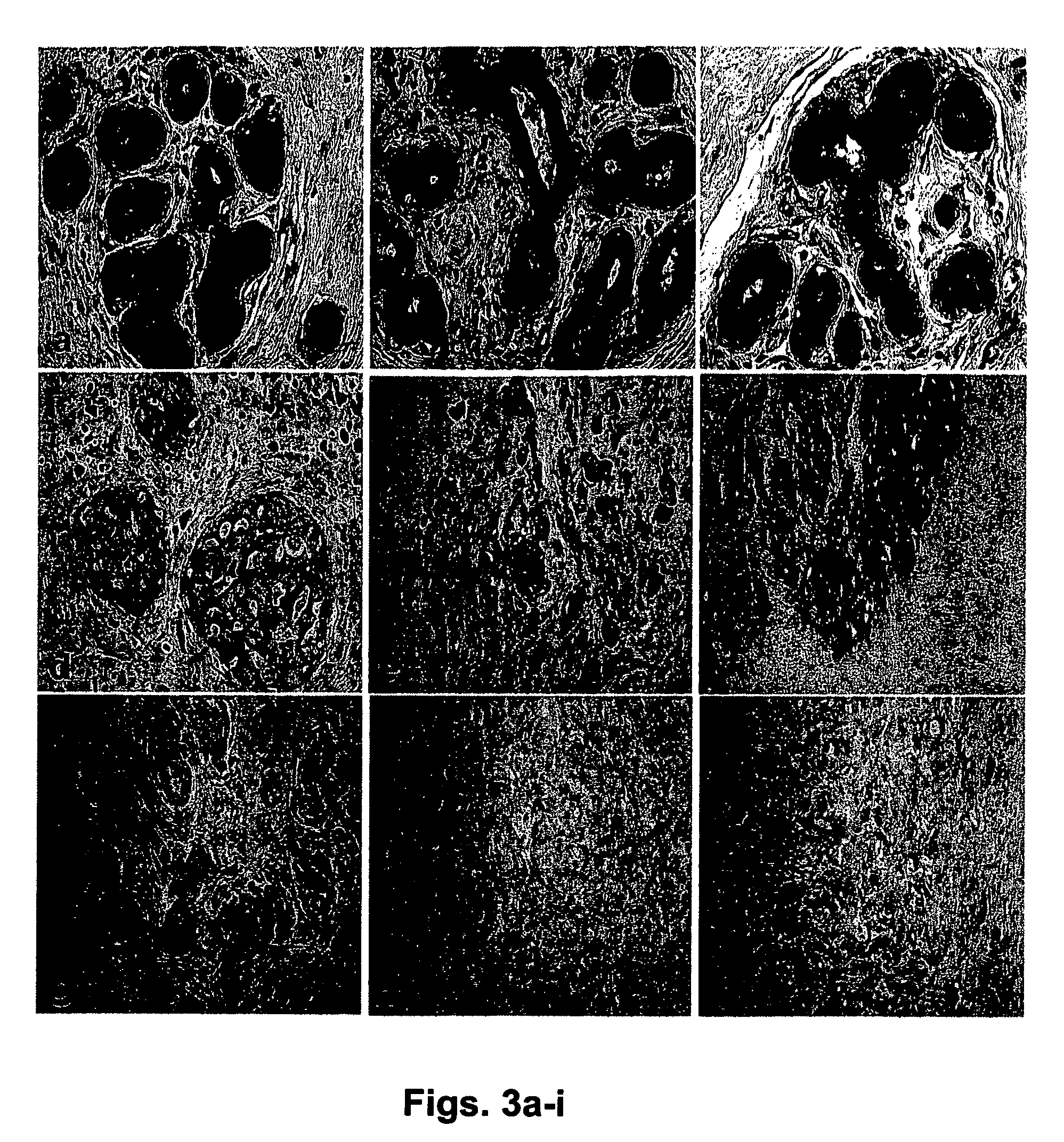 Human Sef isoforms and methods of using same for cancer gene therapy