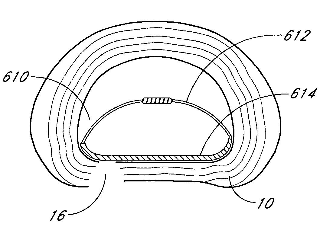 Stabilized intervertebral disc barrier