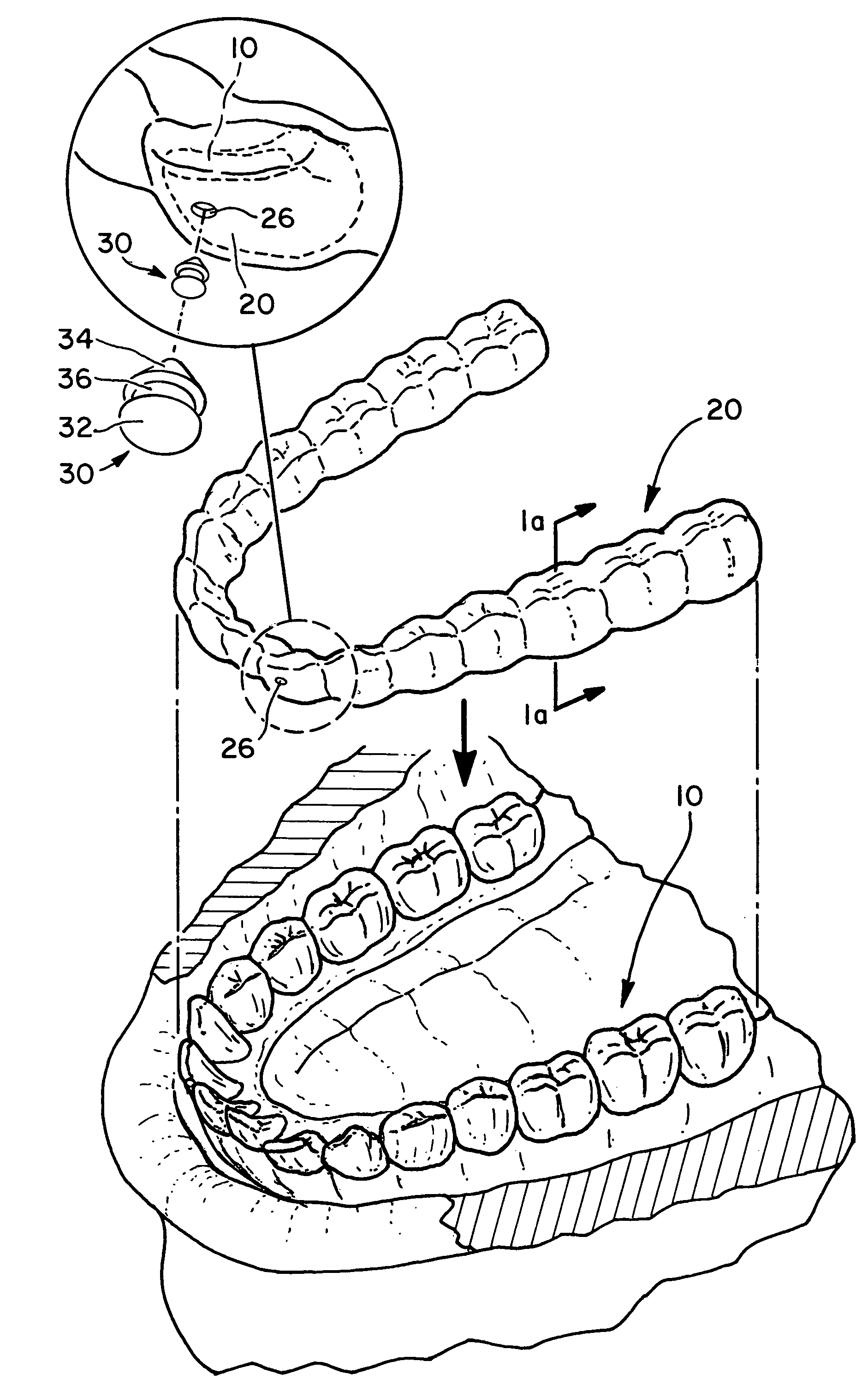 Automated method for producing improved orthodontic aligners