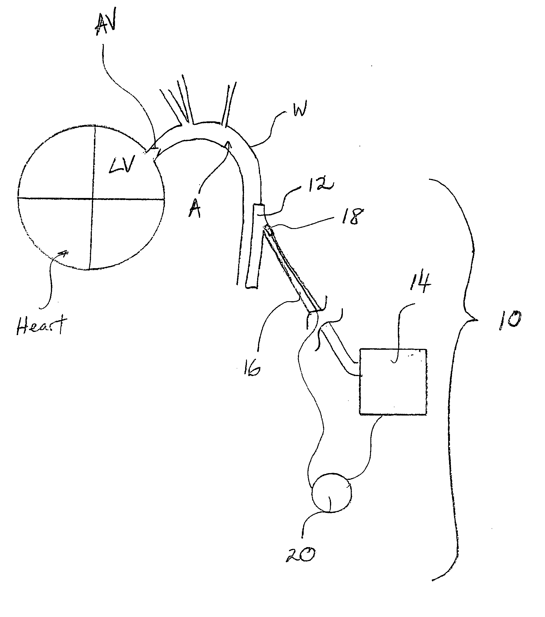 Synchronization system between aortic valve and cardiac assist device