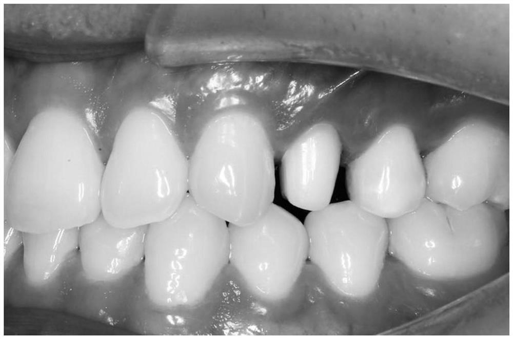 Full-digital repairing method of oral zirconia crown