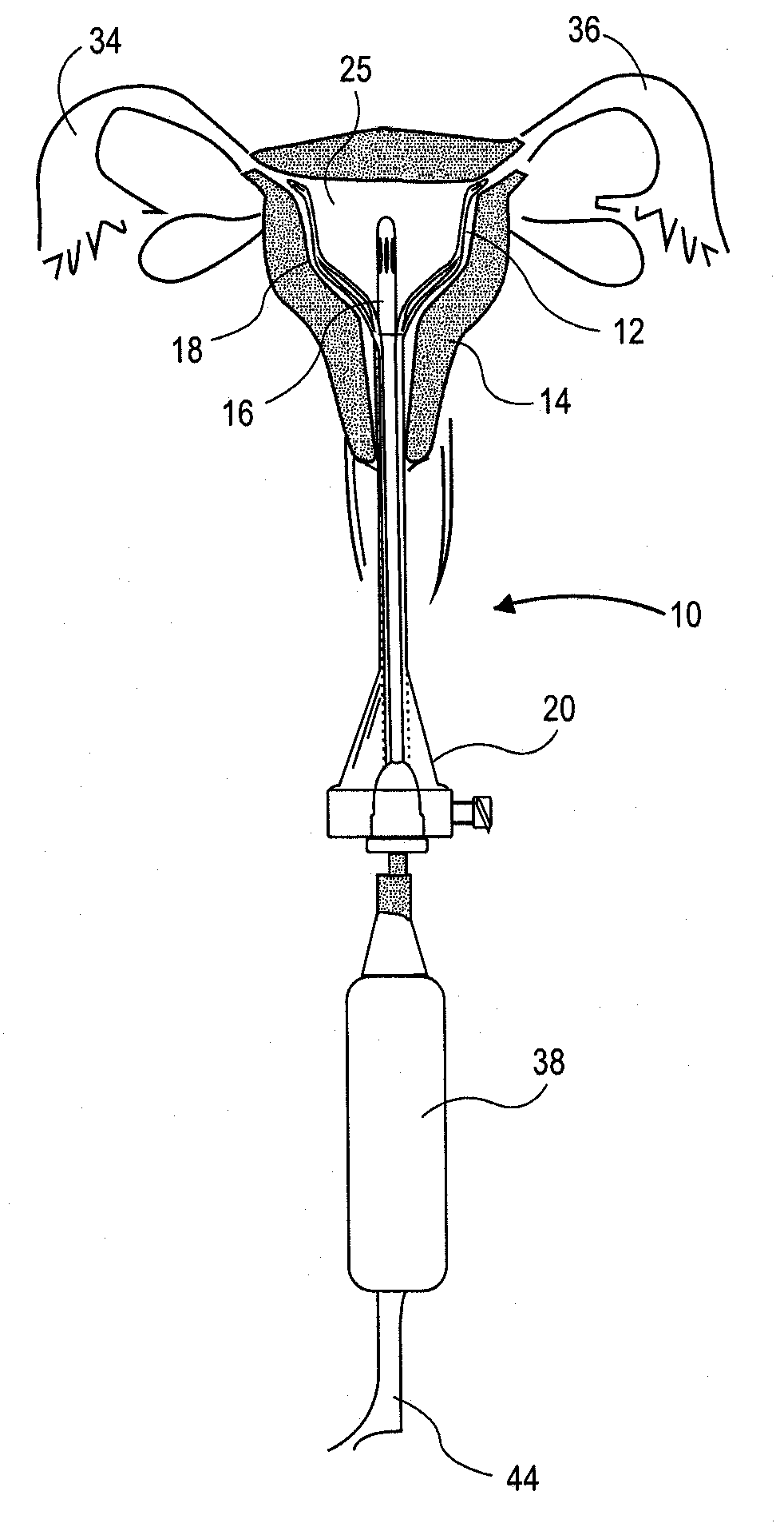 Uterine Therapy Device and Method