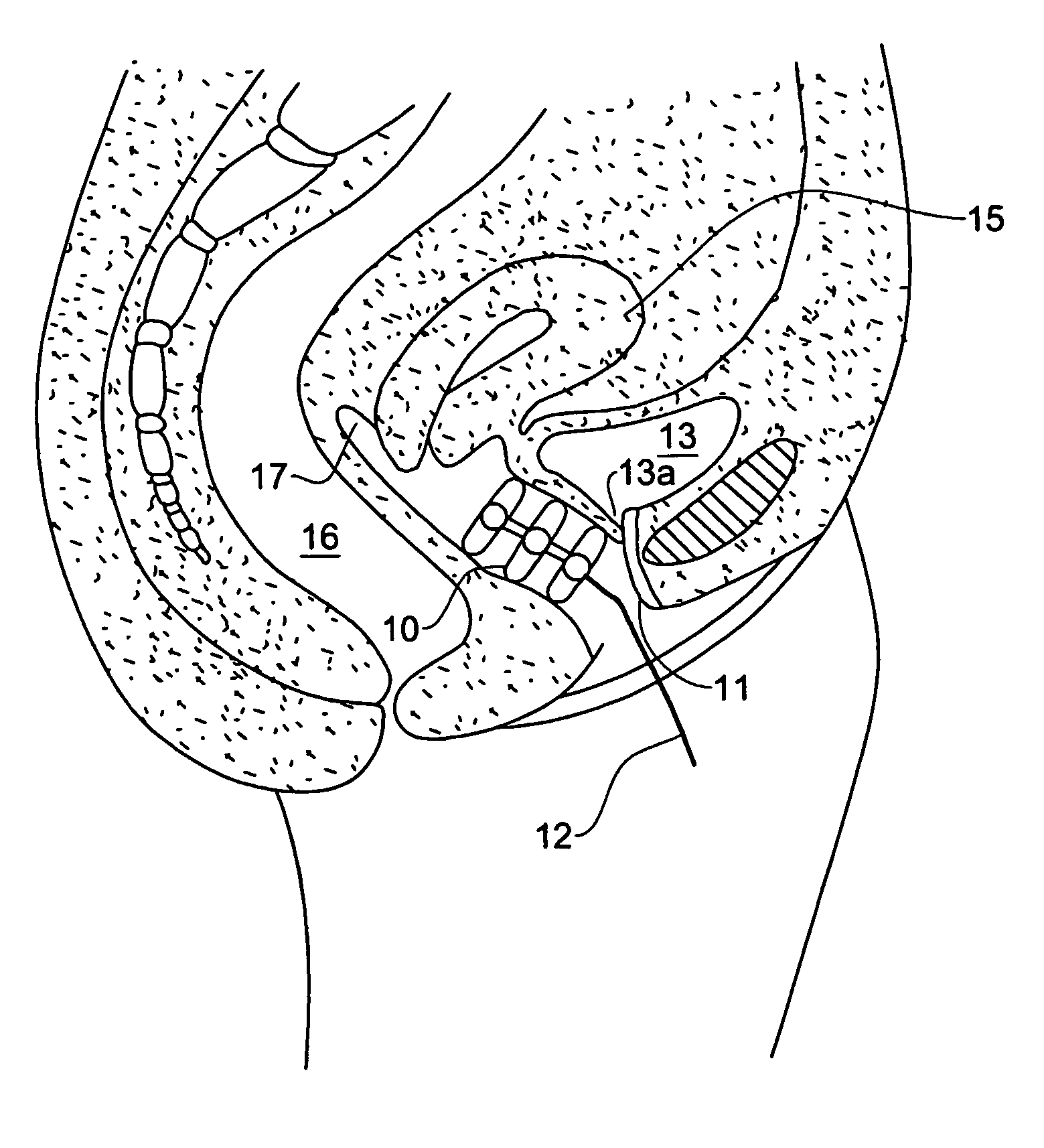Device for the prevention of urinary incontinence in females
