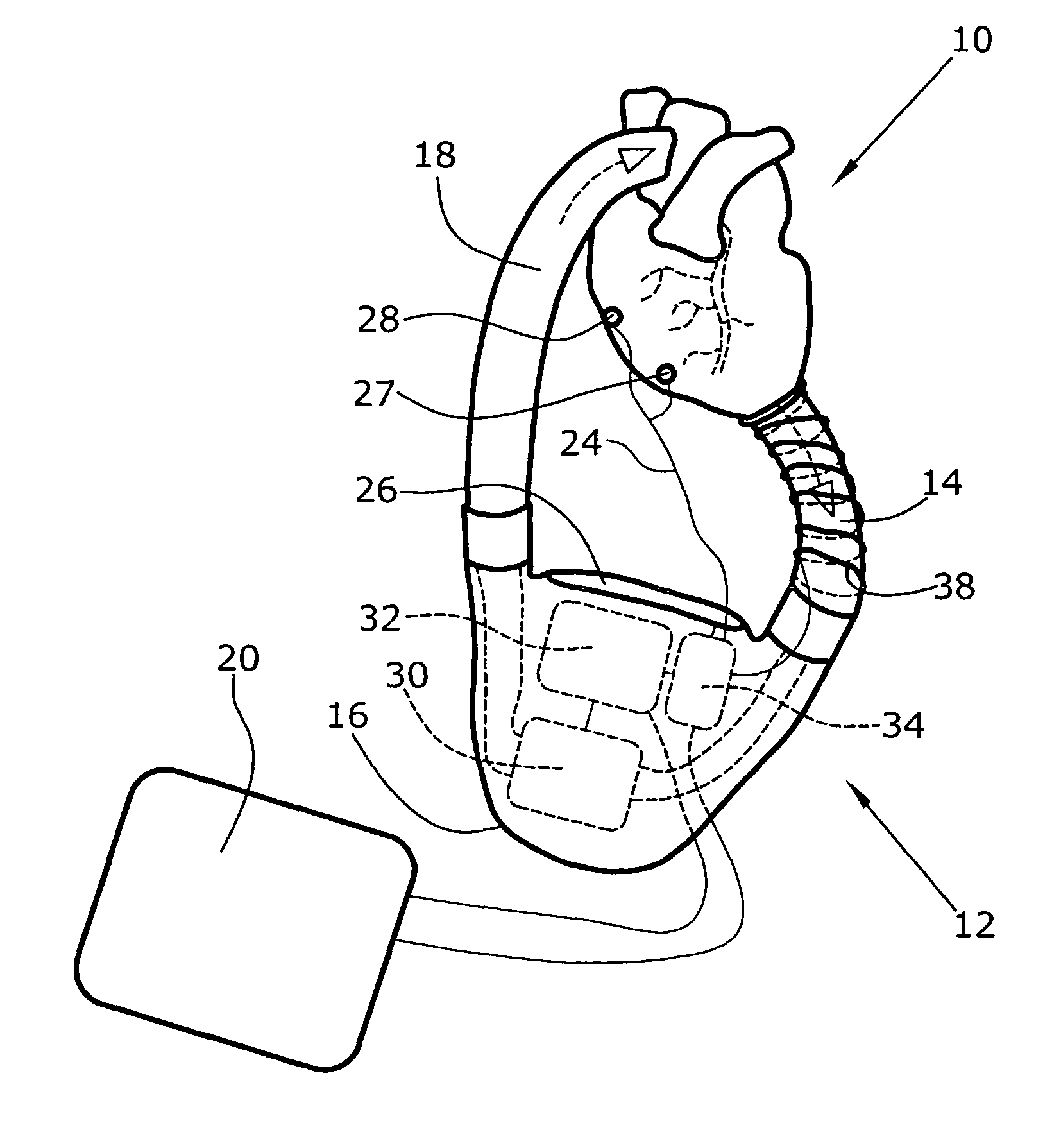 Artificial heart