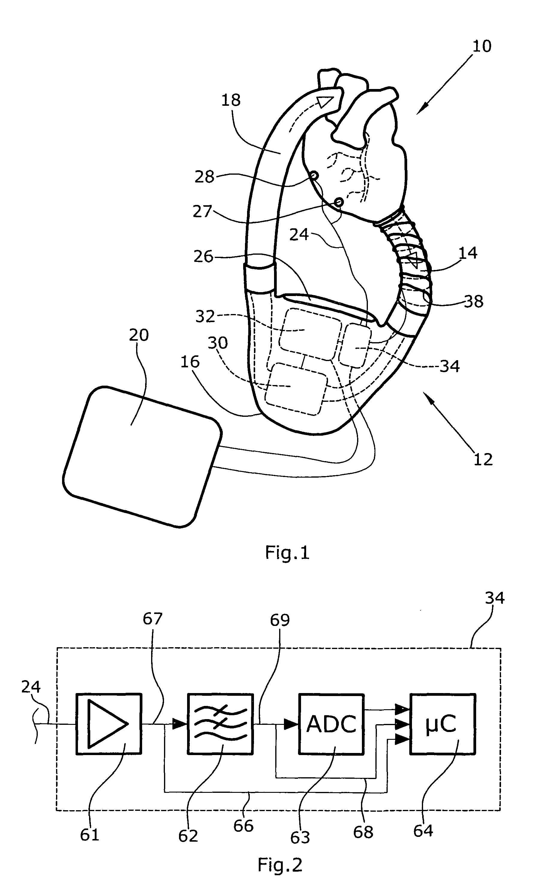 Artificial heart