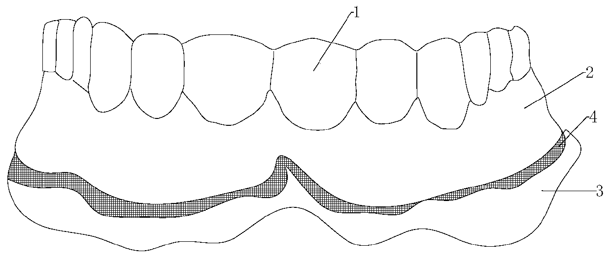 Composite denture with soft lining and preparation method thereof