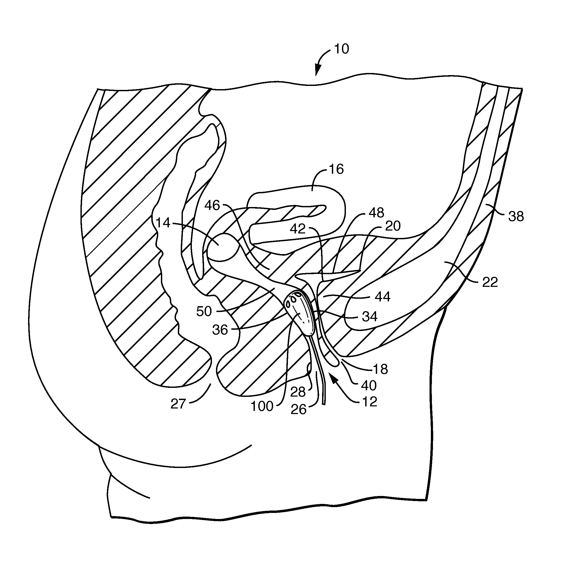Vaginal Insert Device Having a Support Portion with Plurality of Foldable Areas